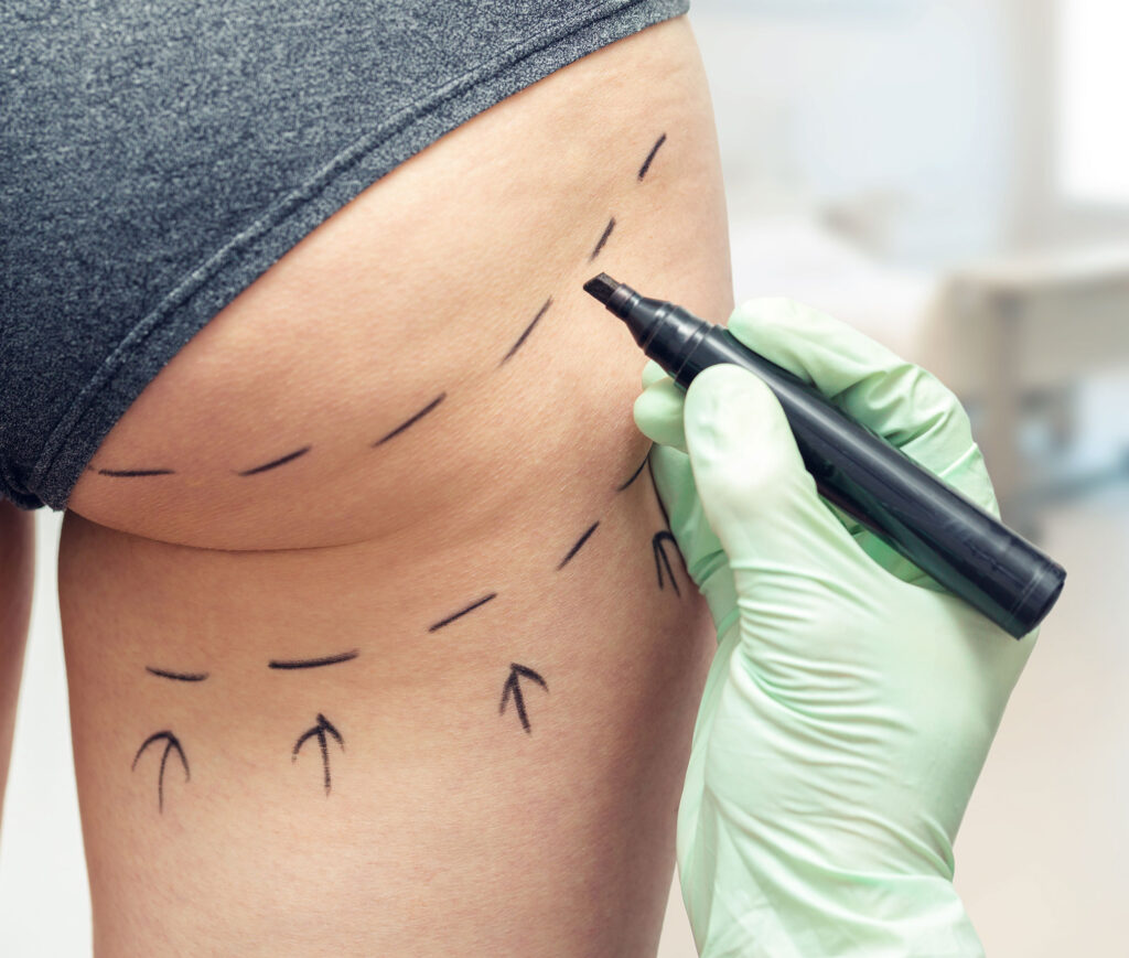 plastic surgeon in a green latex glove marking where the patient will have cellulite removed from their buttocks area