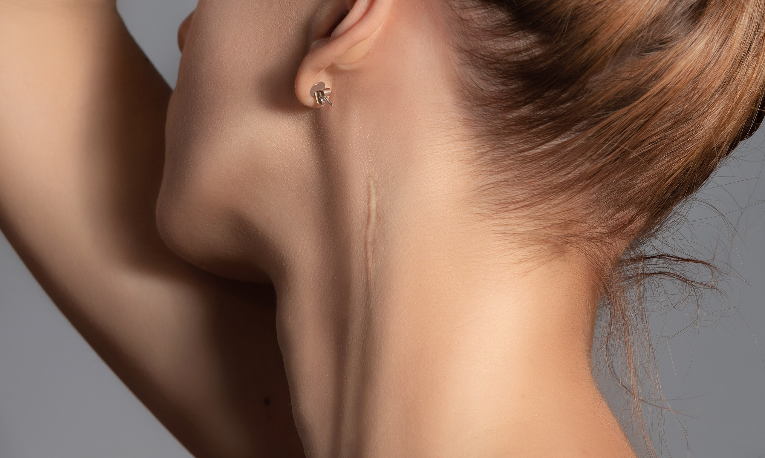 Woman with surgery scar at her neck.