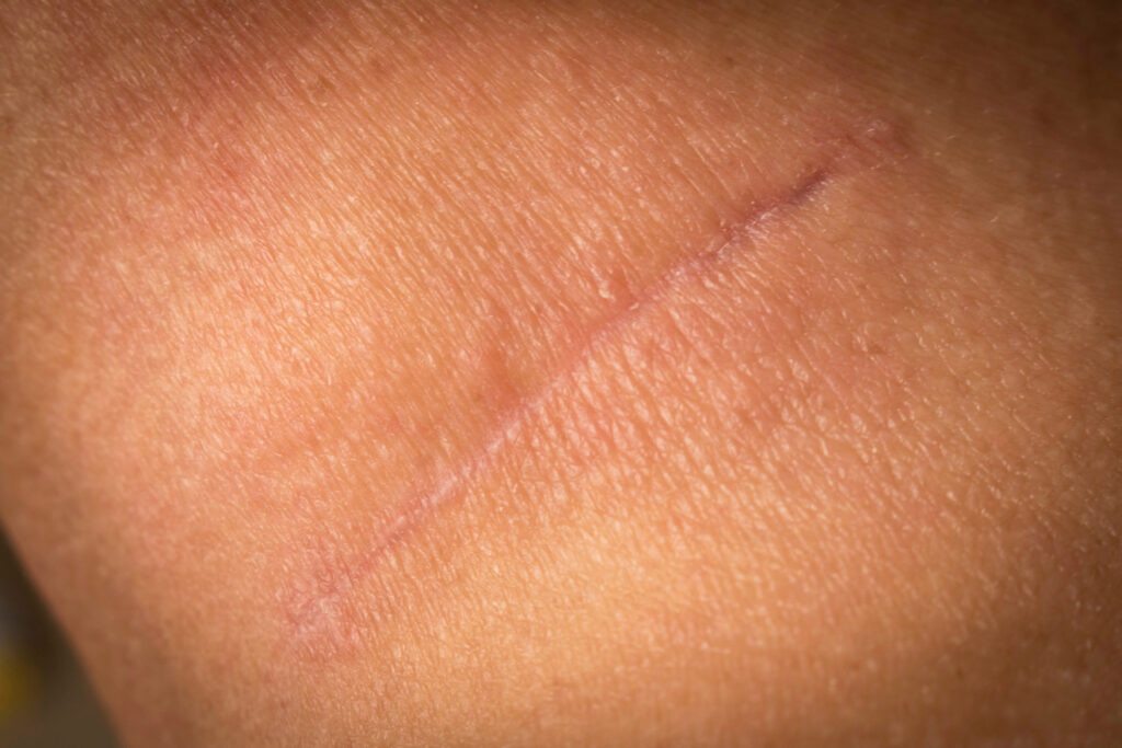 Suture after surgery on the human neck. The scar after the surgery. Close up