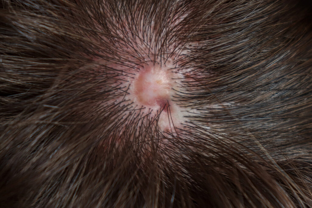 View of legion on the top of the head.