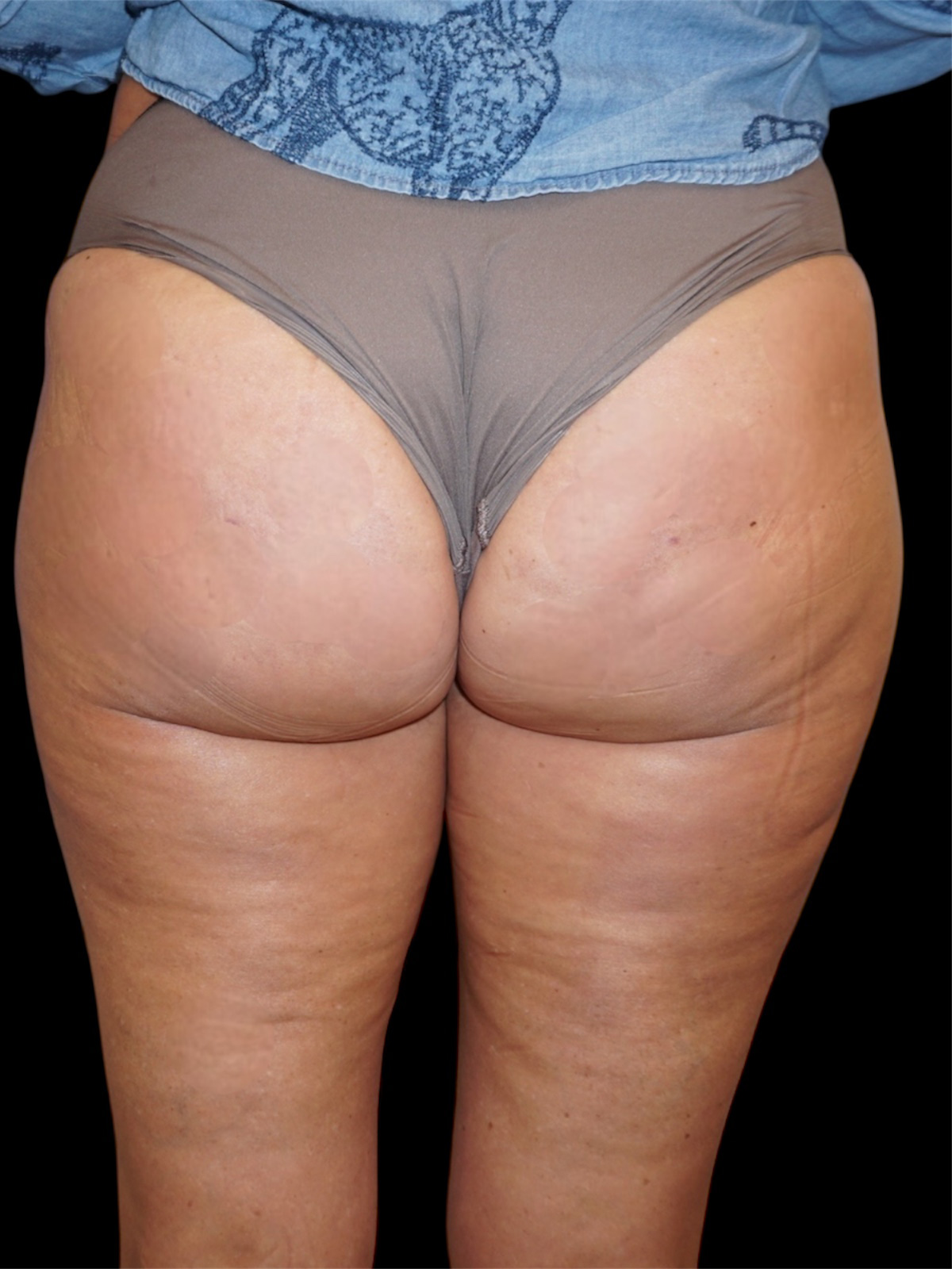 Aveli Patient 1 After