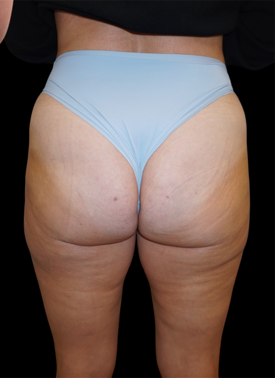 Aveli Patient 2 After