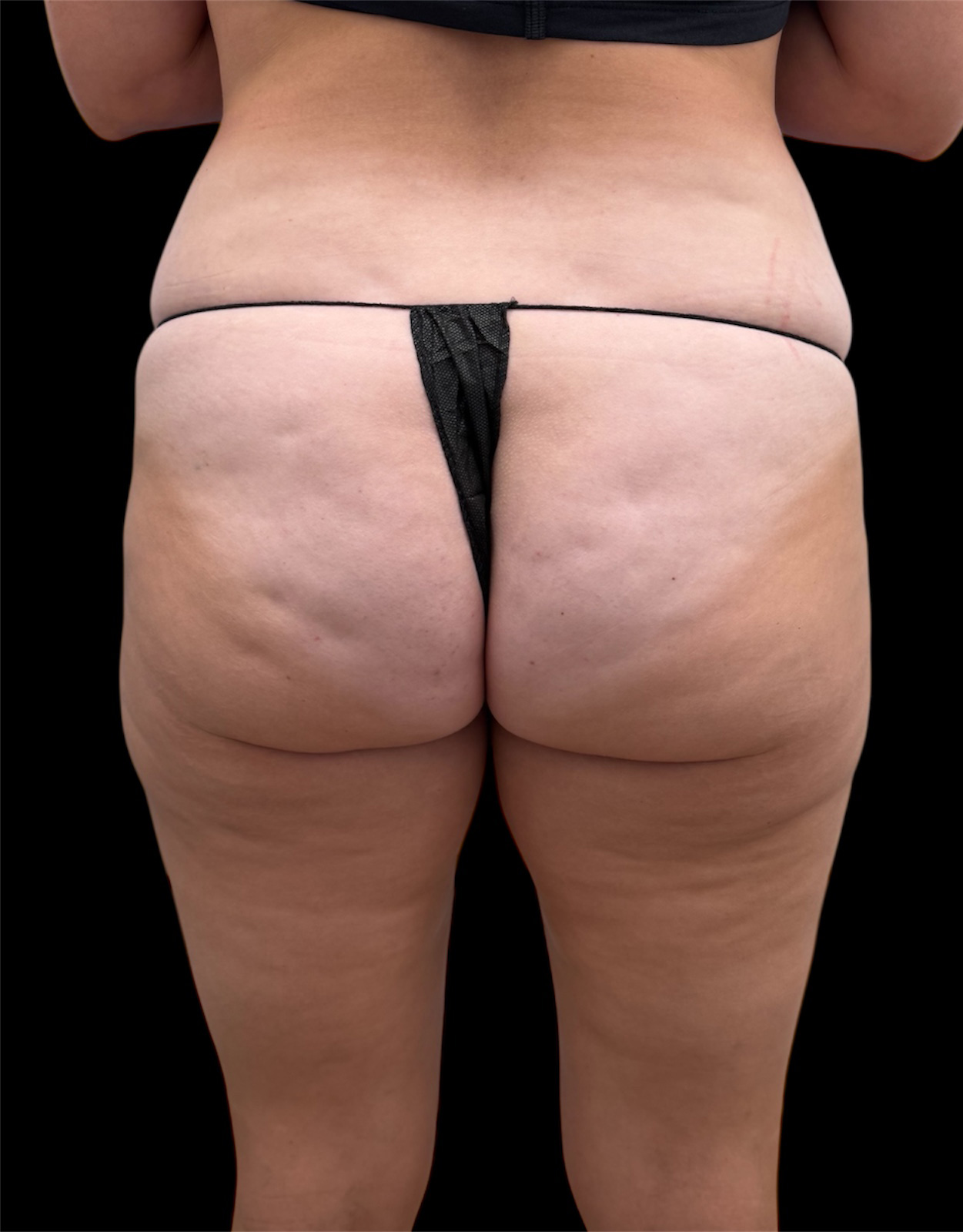 Aveli Patient 2 Before