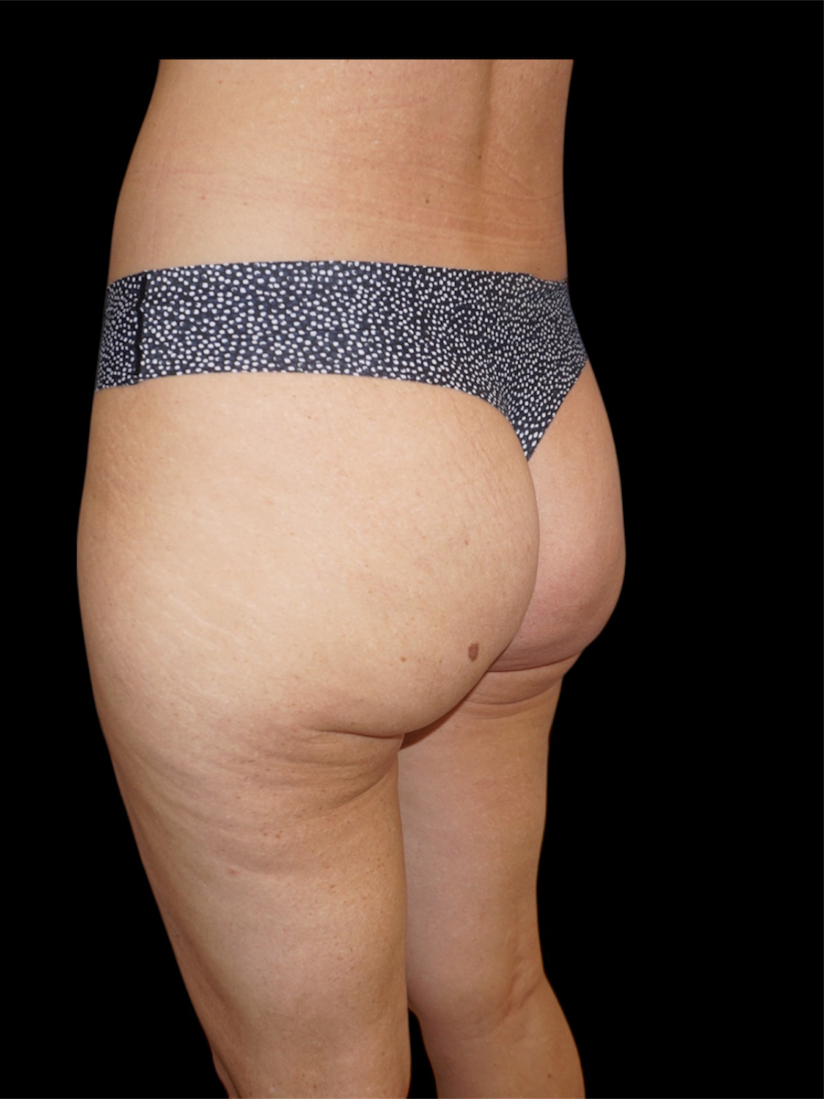 Aveli Patient 3 After