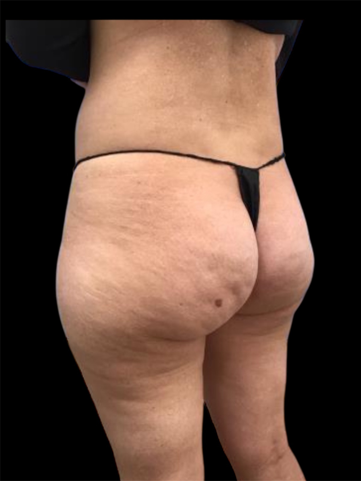 Aveli Patient 3 Before