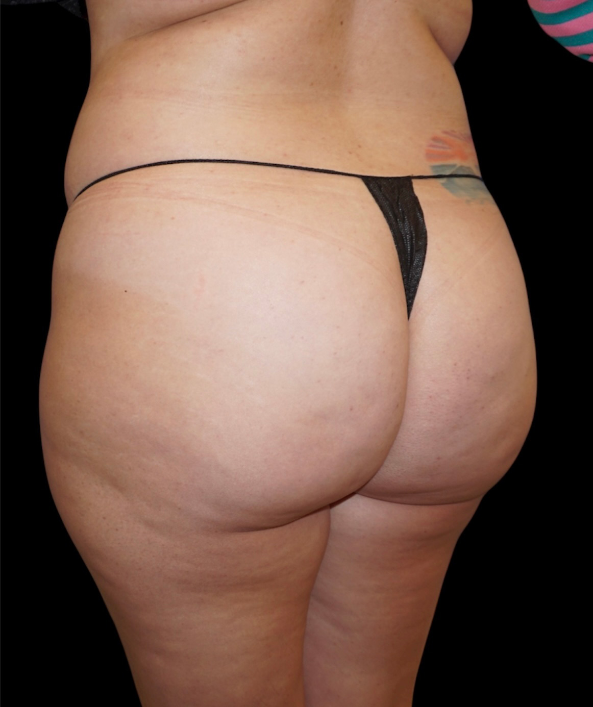 Aveli Patient 4 Before