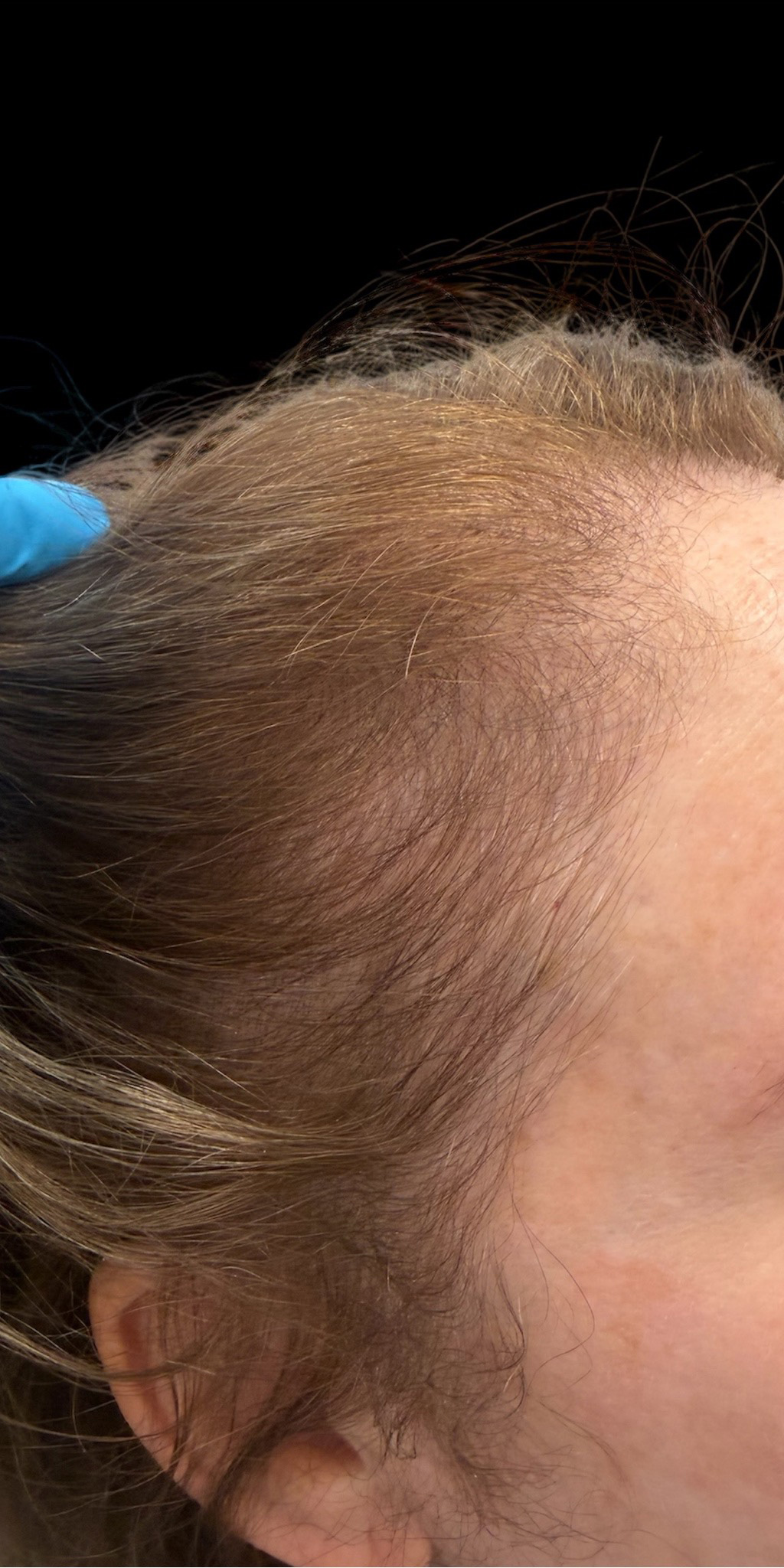 Hair Growth Patient 1 After