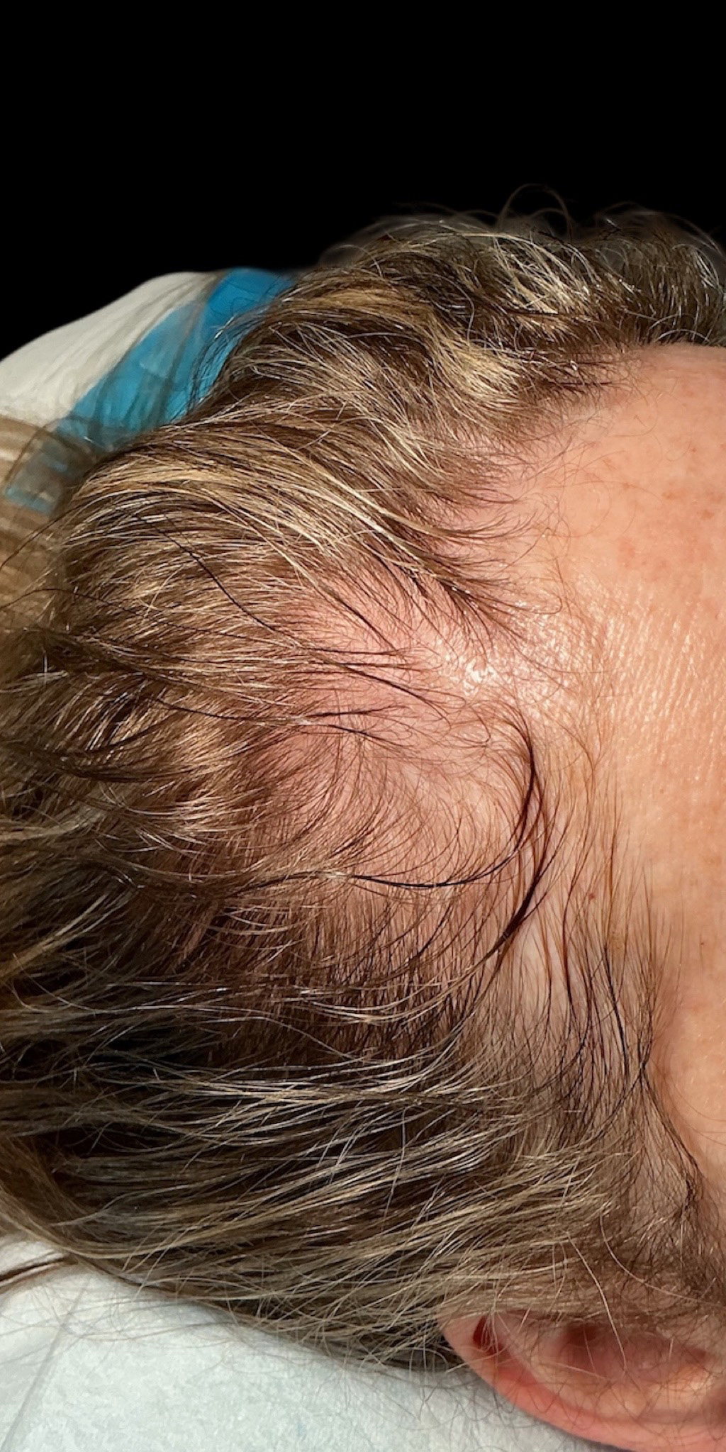 Hair Growth Patient 1 Before