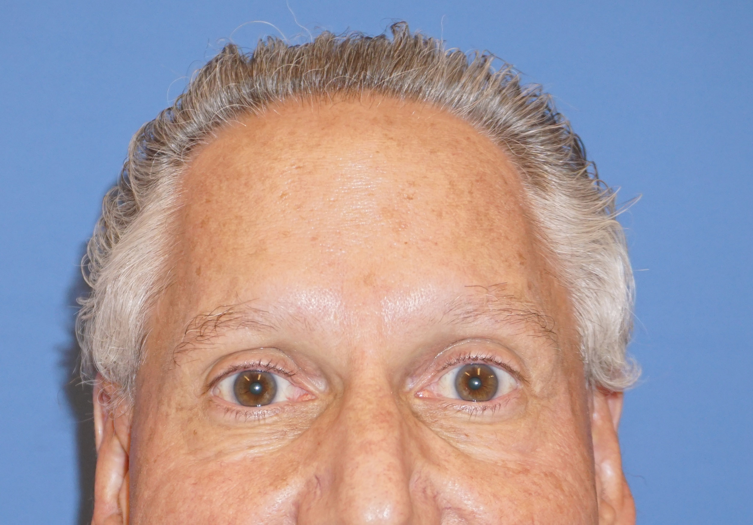 Botox – Patient 1 After