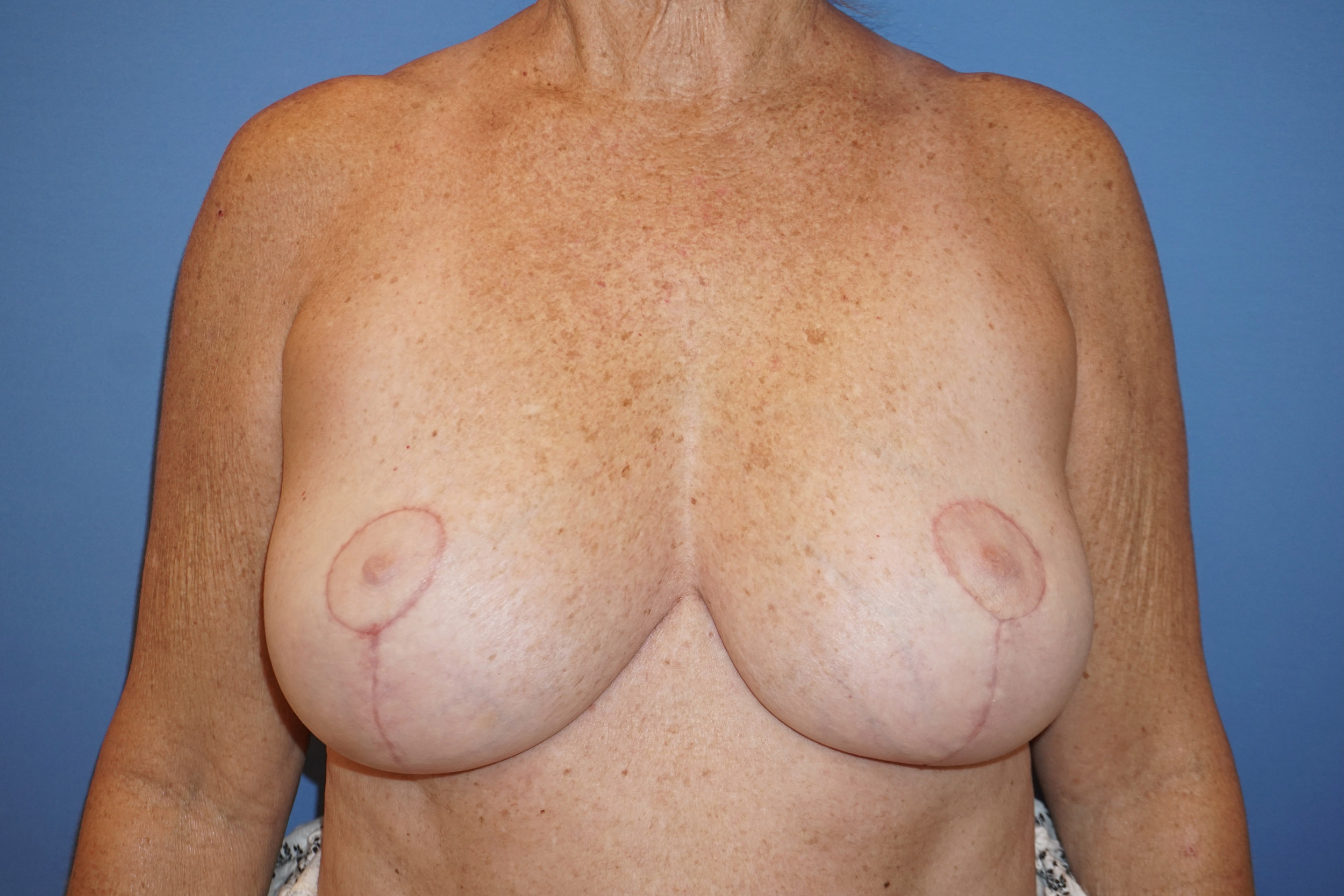 Breast Implant Removal – Patient 1 After