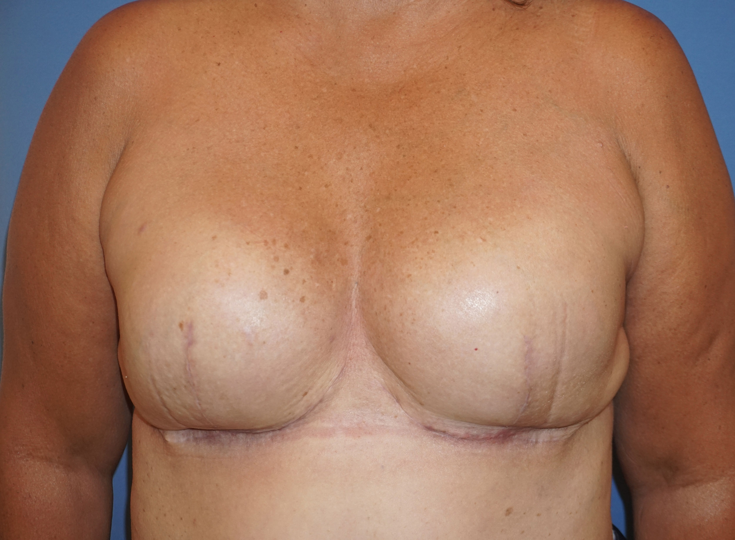 Breast Reconstruction for Cancer – Patient 1 After