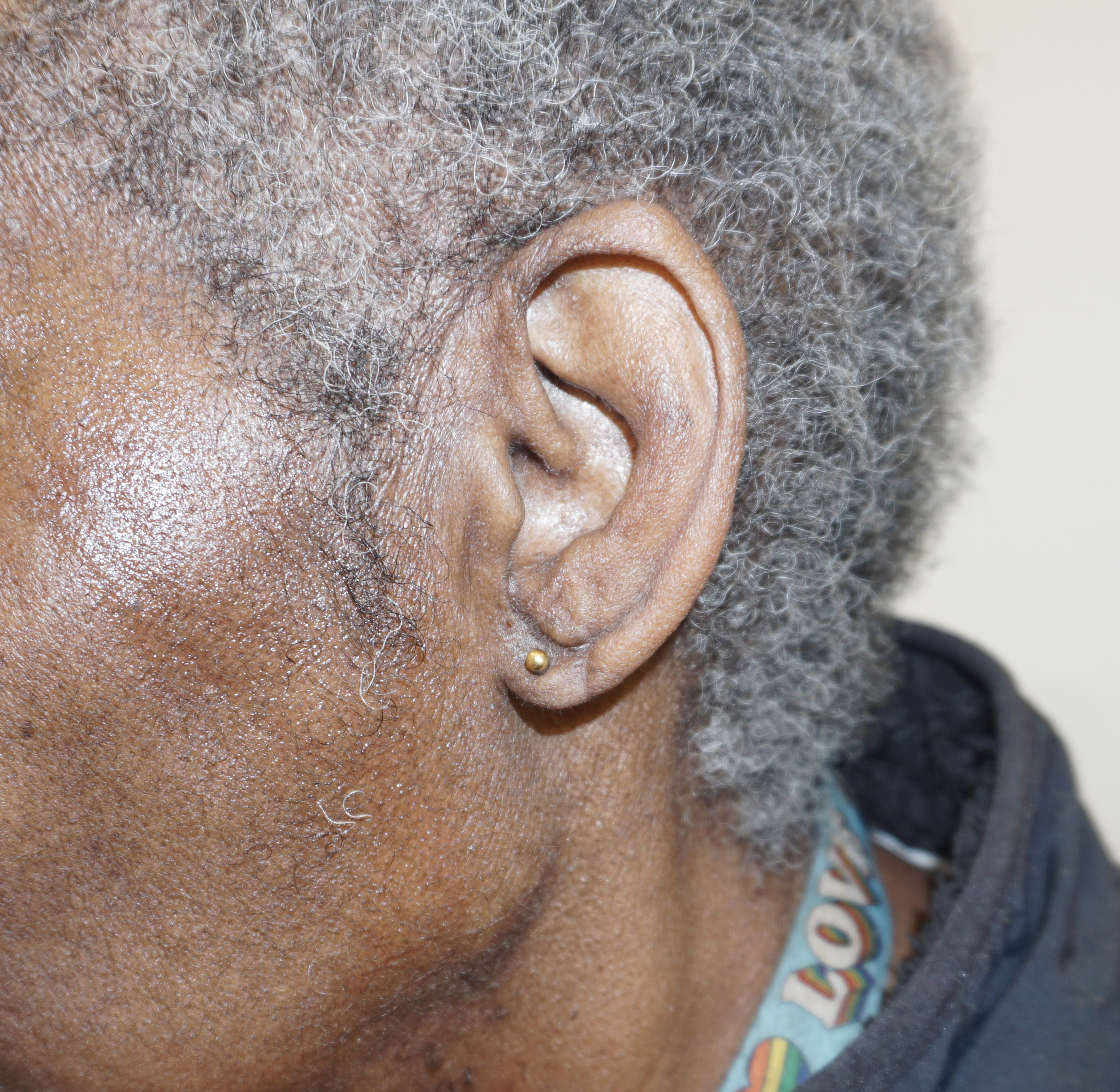 Ear Surgery – Patient 1 After