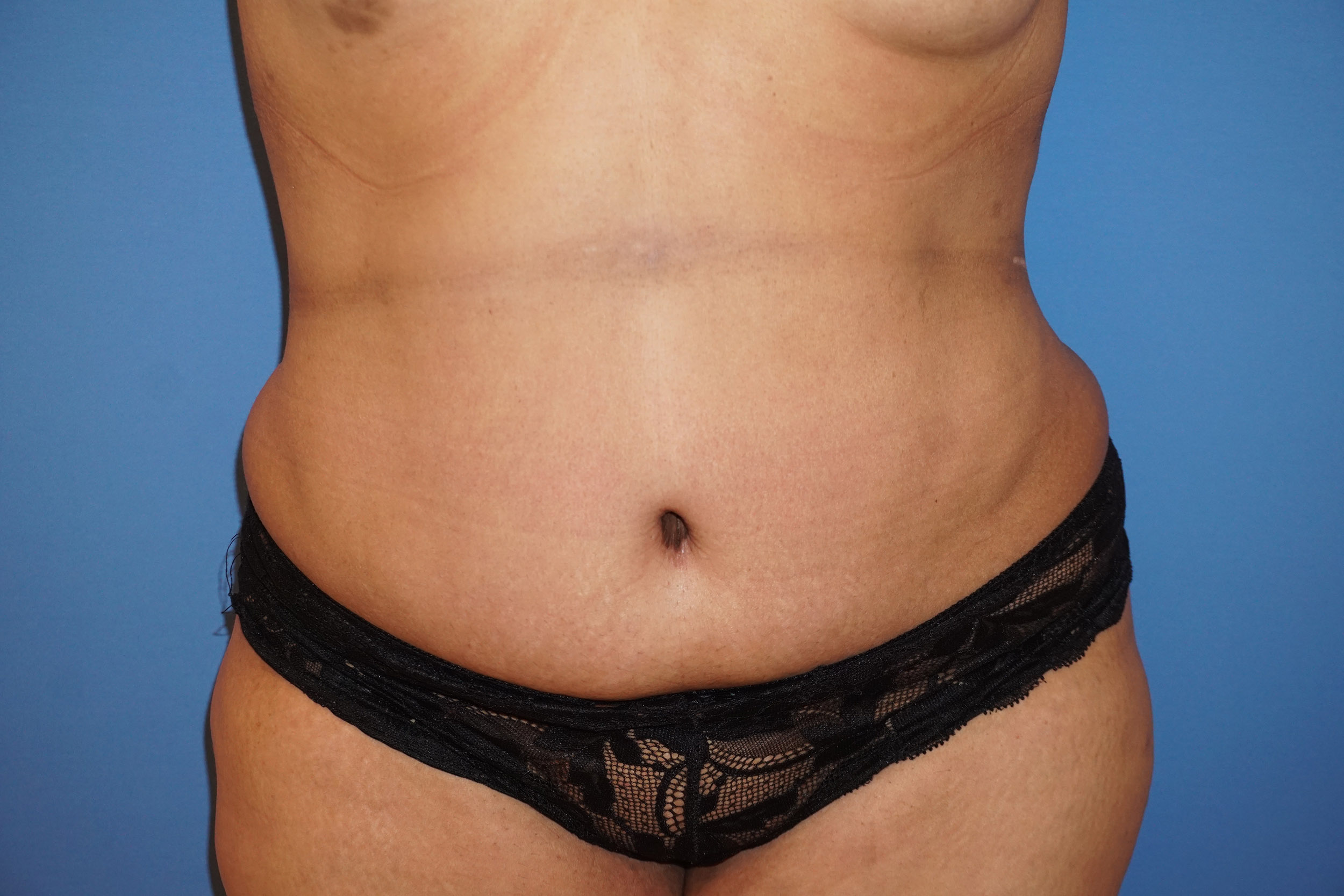 Tummy Tuck – Patient 1 After