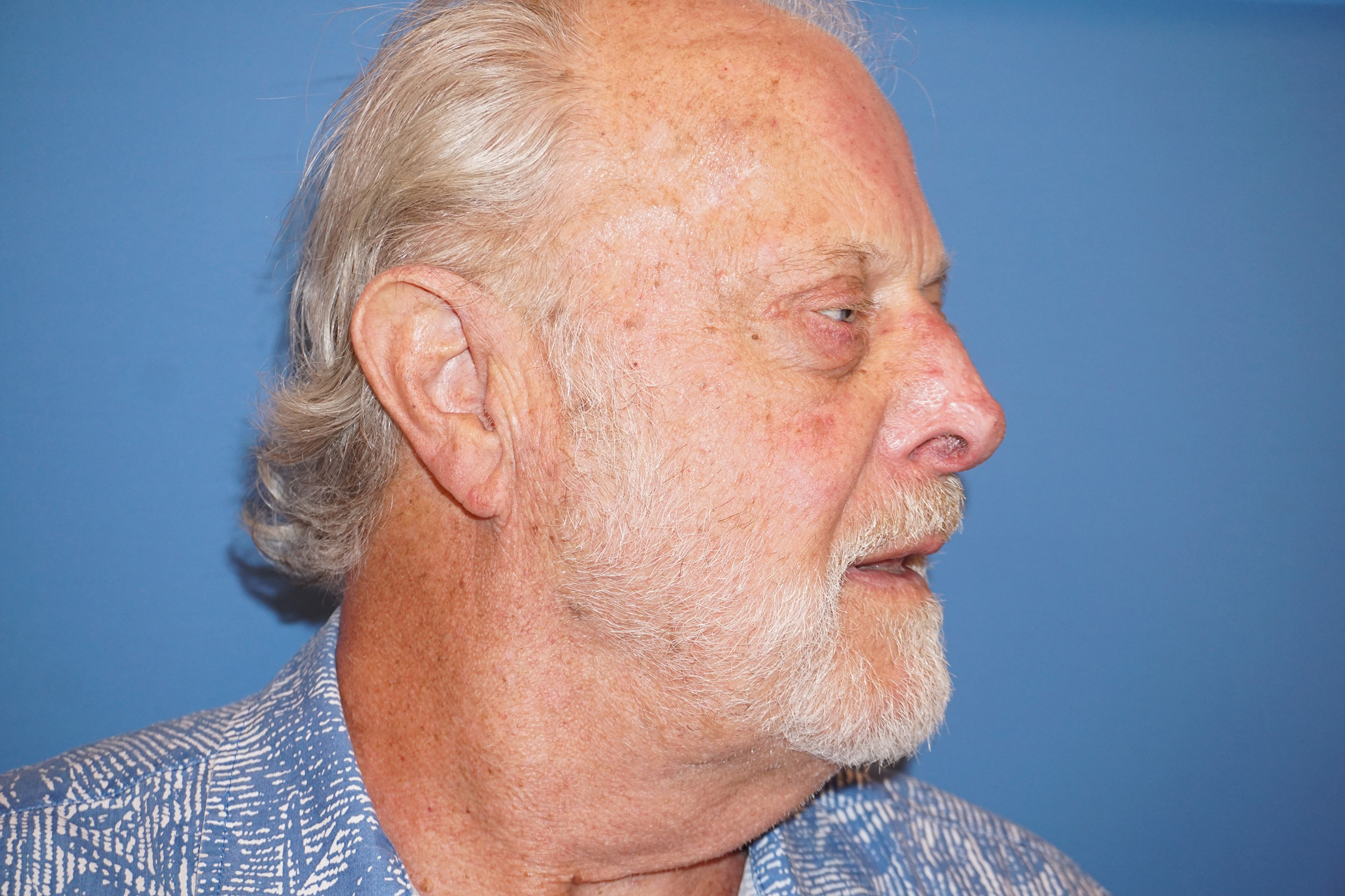 Nose Reshaping Patient 1 After