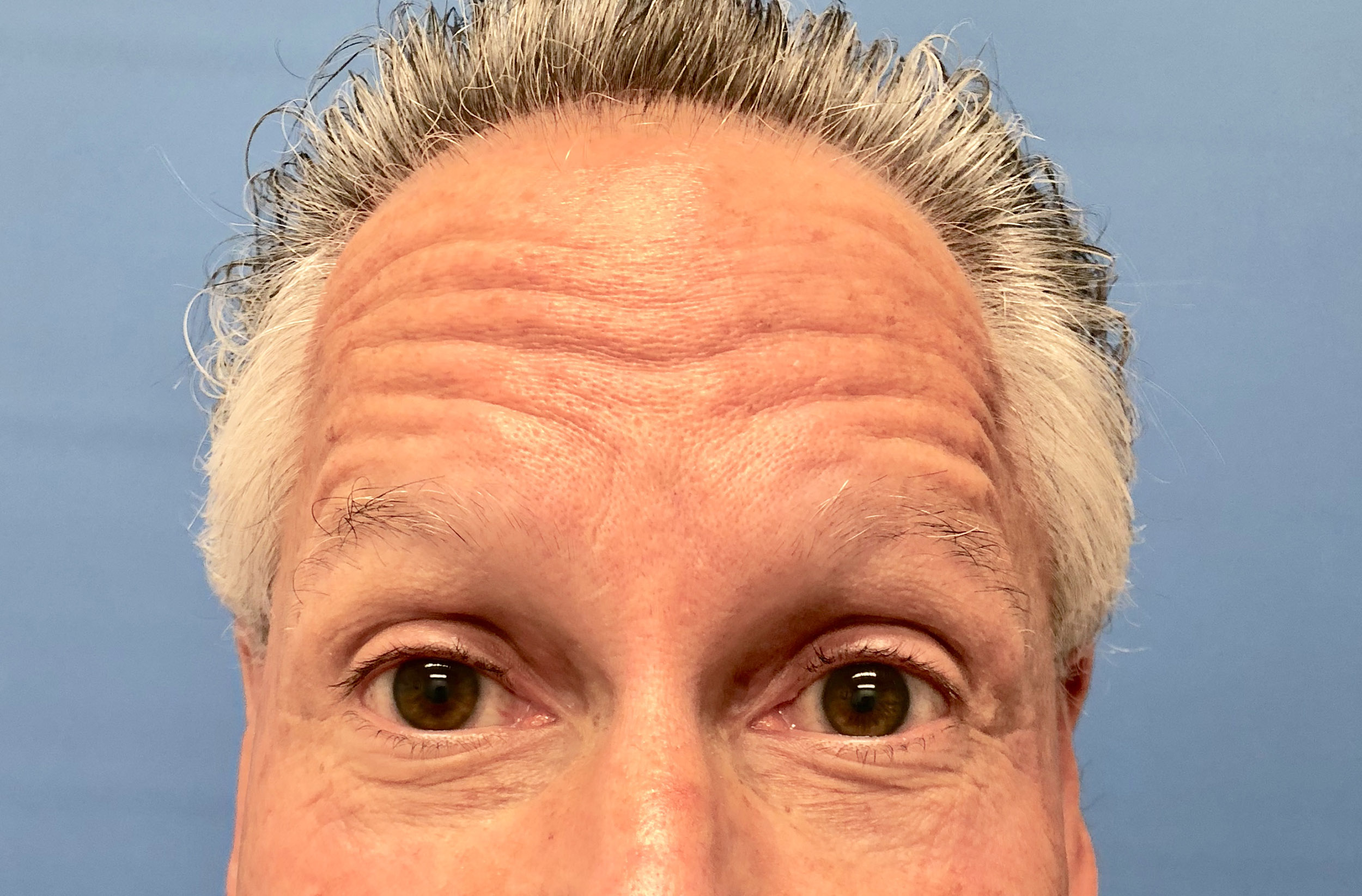 Botox – Patient 1 Before
