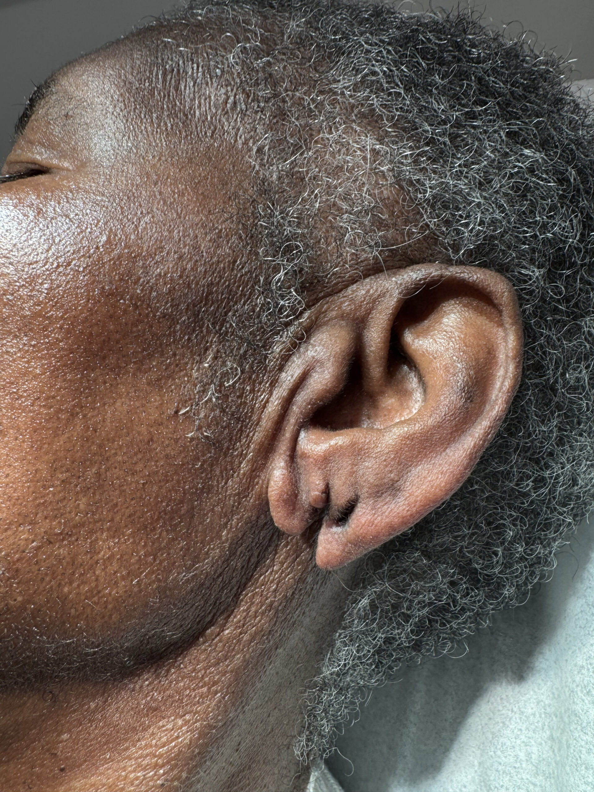 Ear Surgery – Patient 1 Before