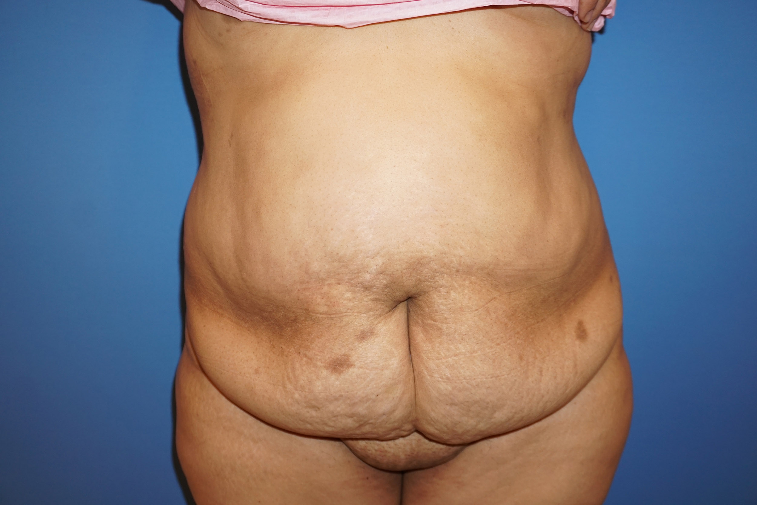 Tummy Tuck – Patient 1 Before