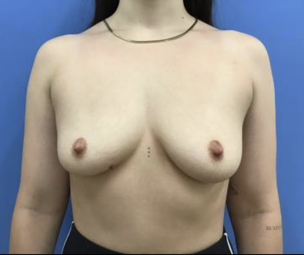 Breast Augmentation – Patient 1 Before