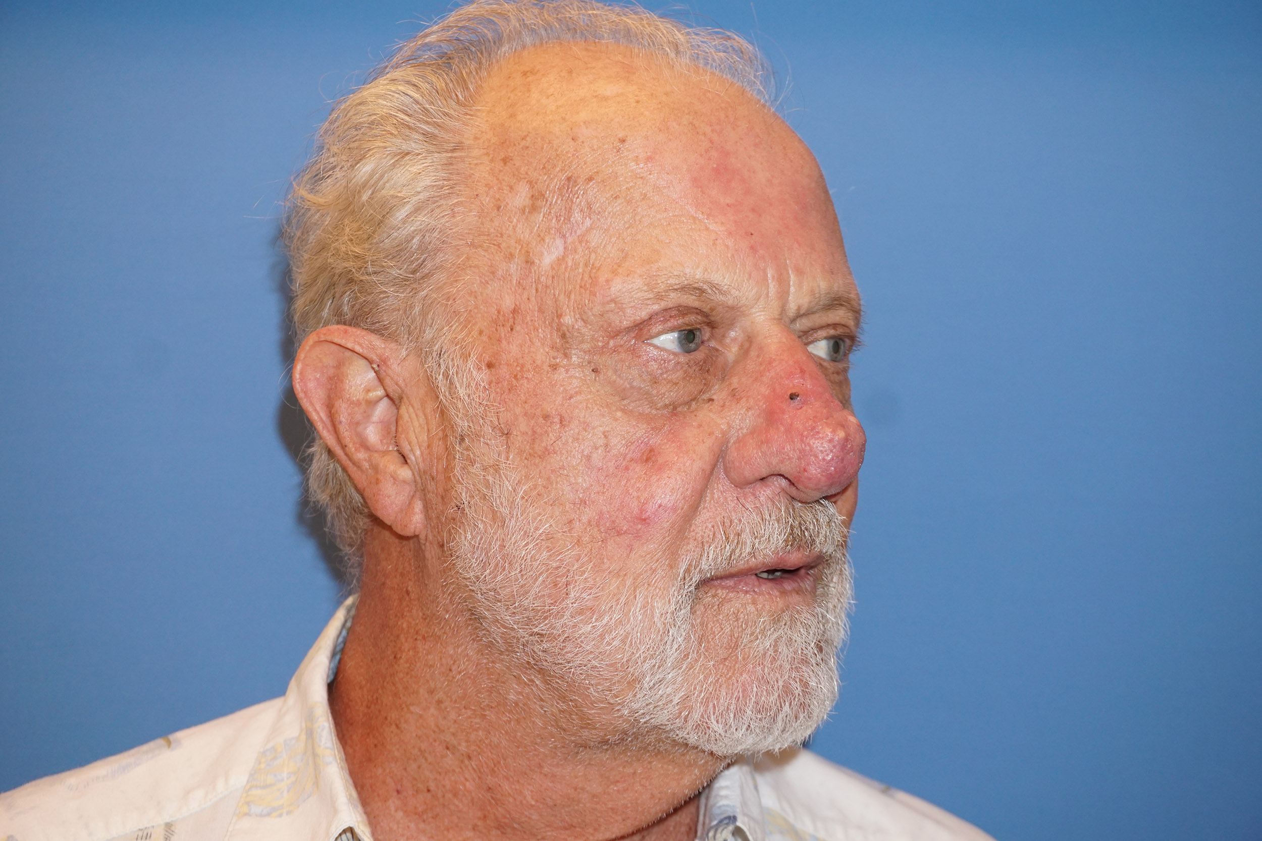 Nose Reshaping Patient 1 Before