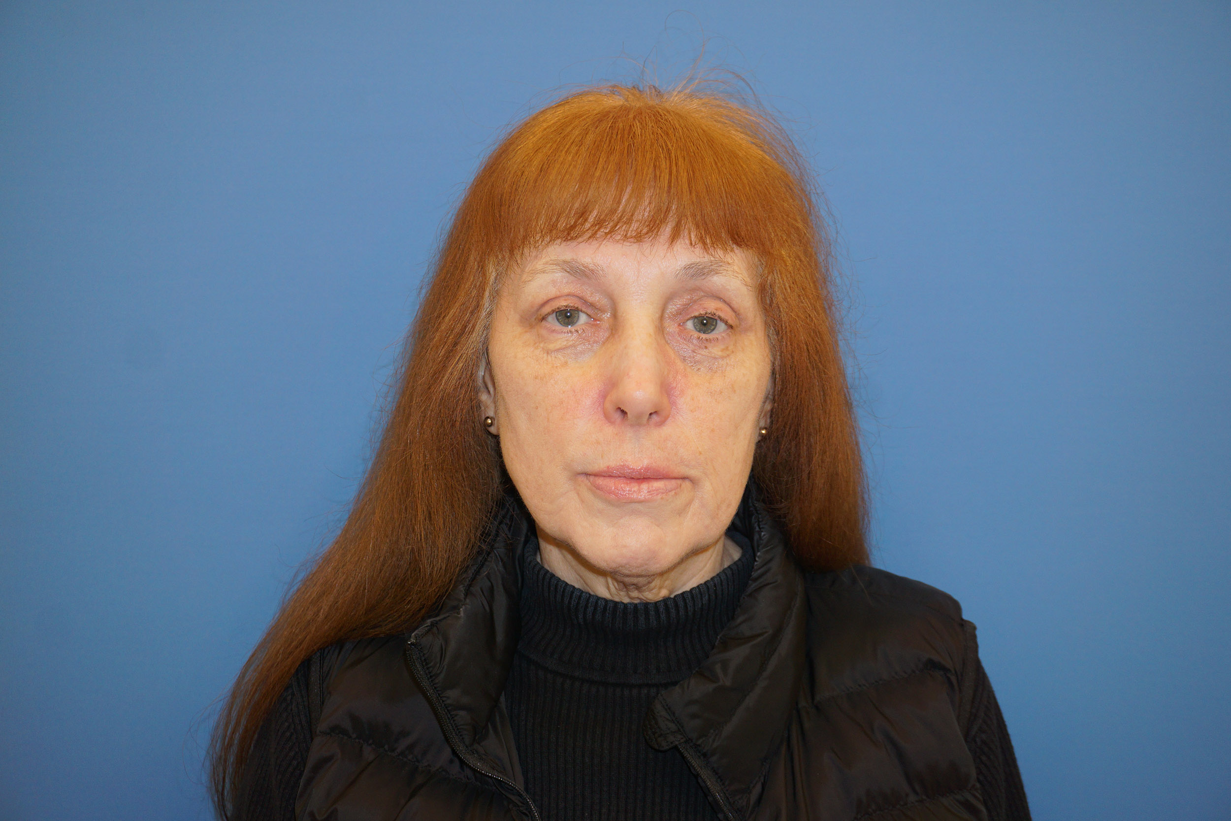 Blepharoplasty Patient 1 After