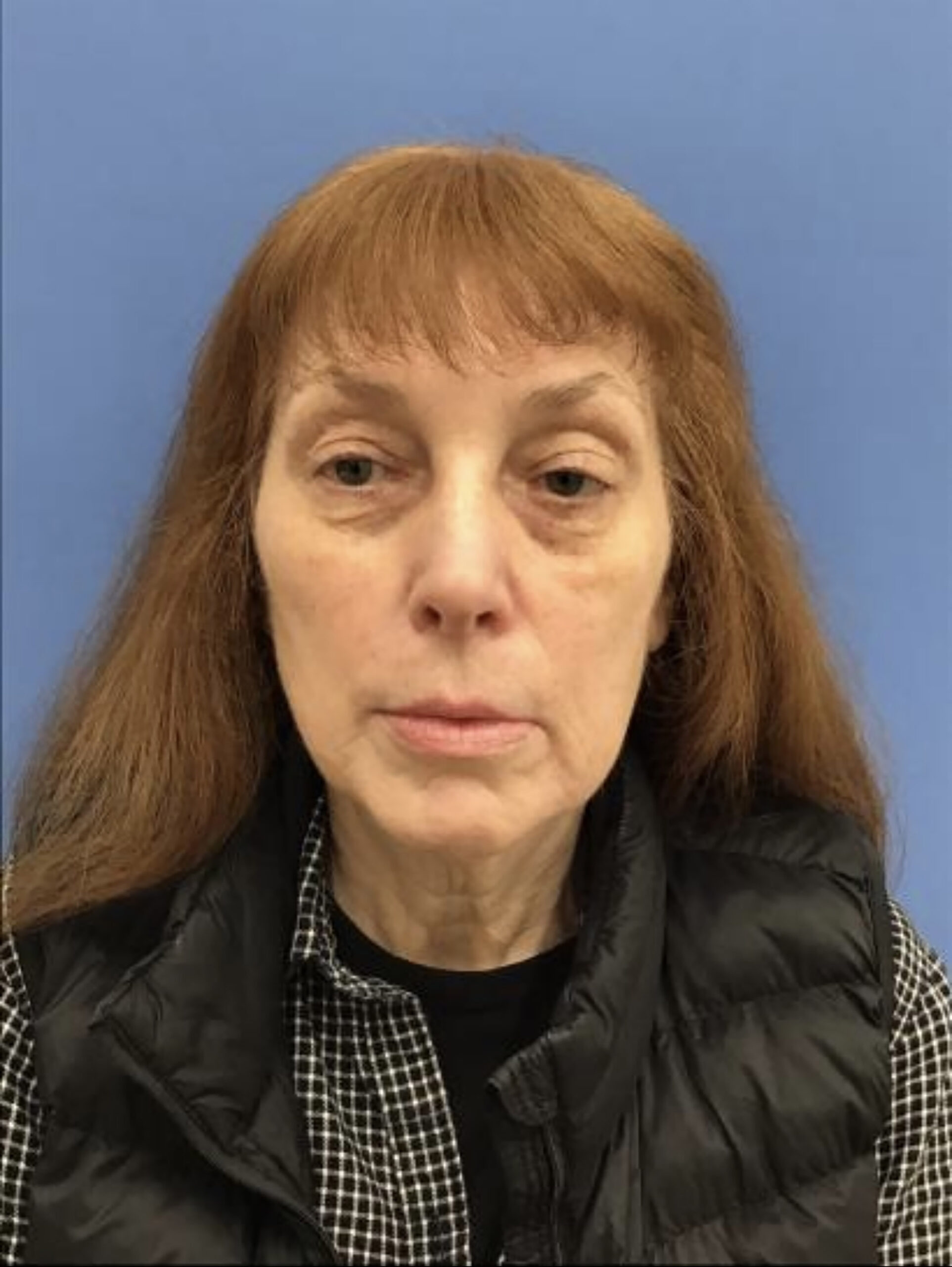 Blepharoplasty Patient 1 Before