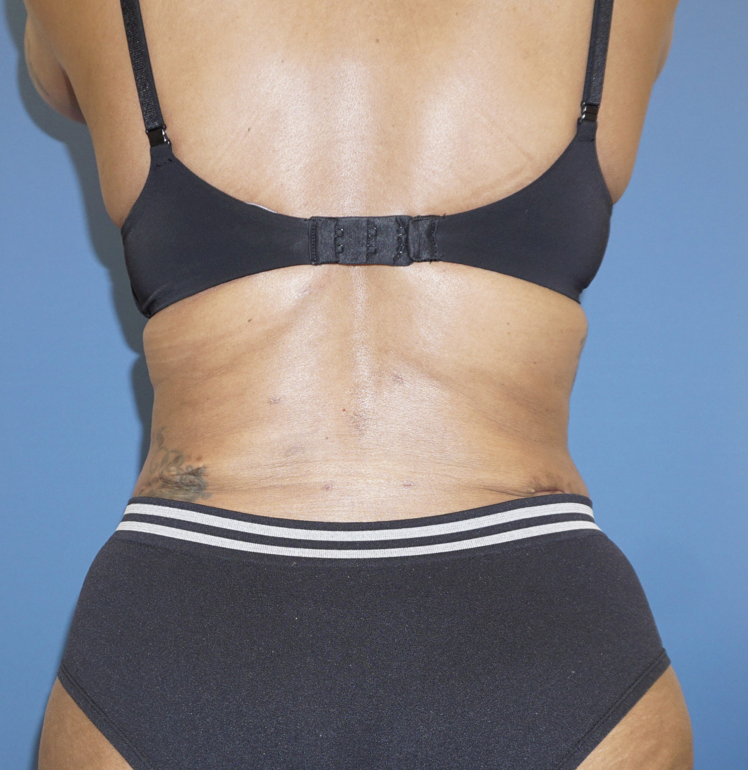 Liposuction – Patient 10 After