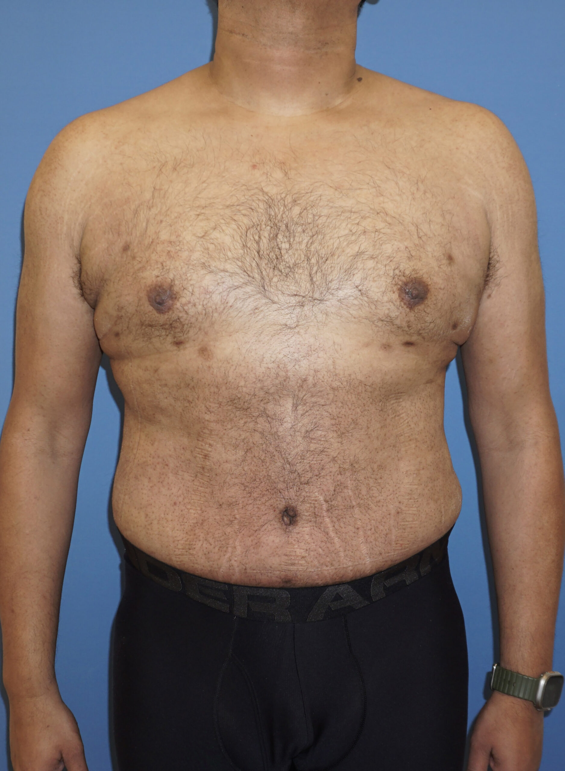 Tummy Tuck – Patient 10 After