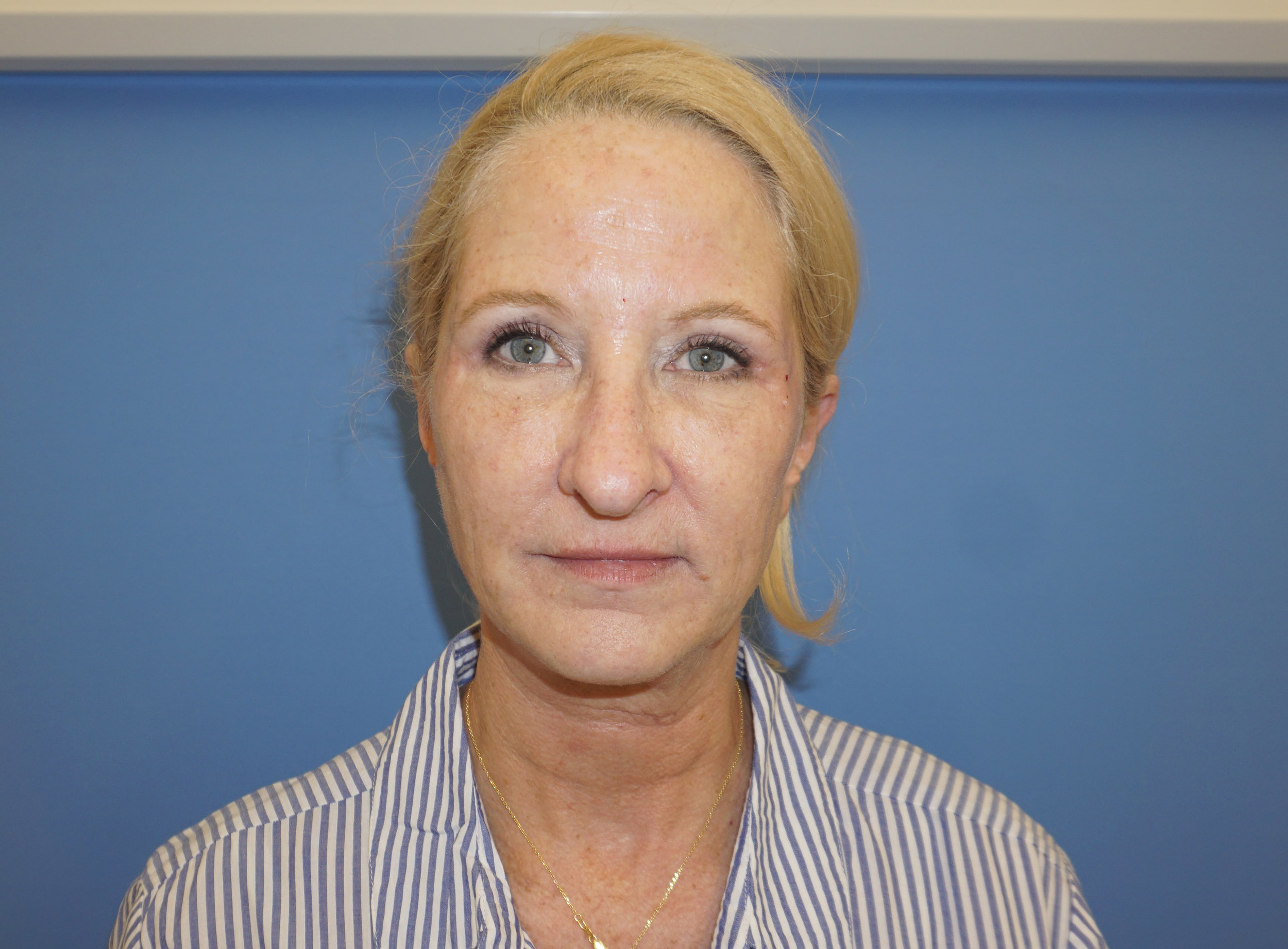Blepharoplasty – Patient 10 After