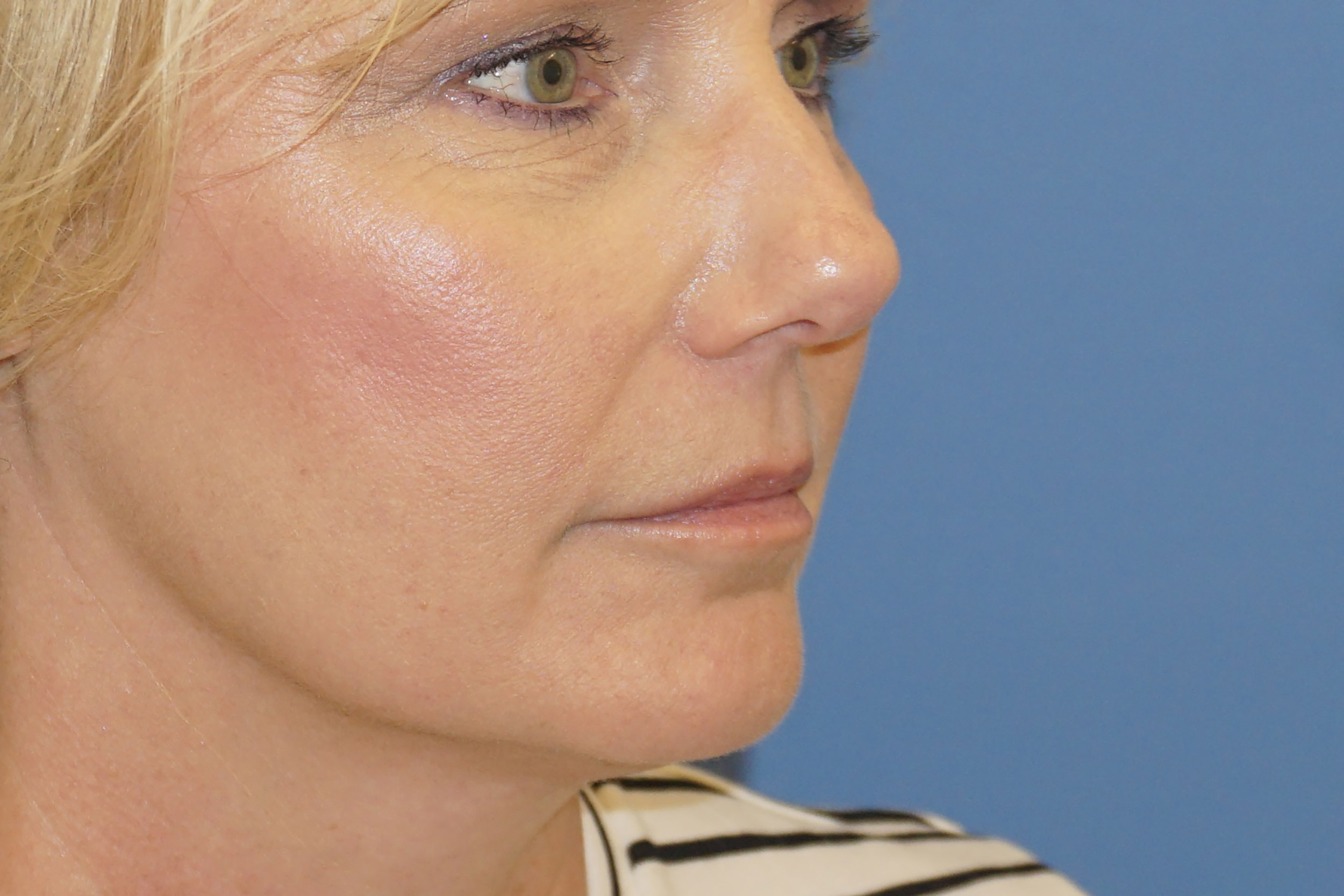 Botox – Patient 10 Before