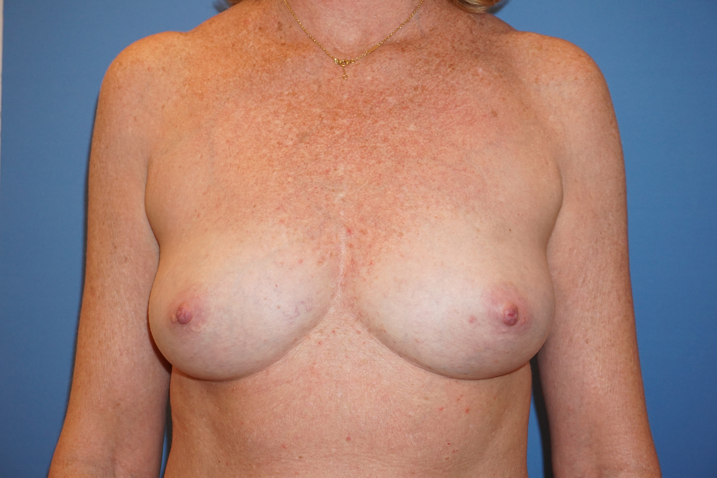 Breast Reconstruction for Cancer – Patient 10 Before