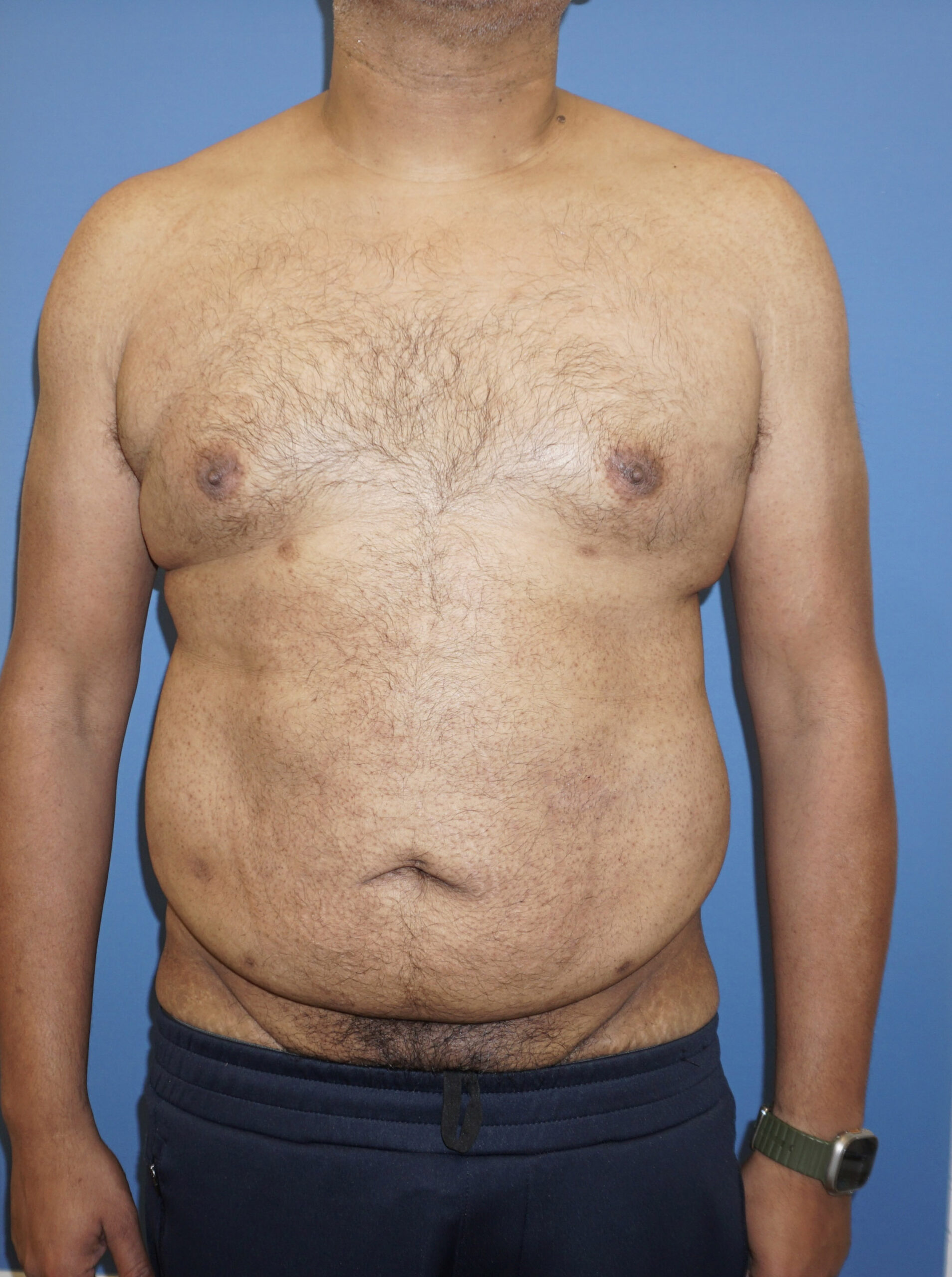 Tummy Tuck – Patient 10 Before