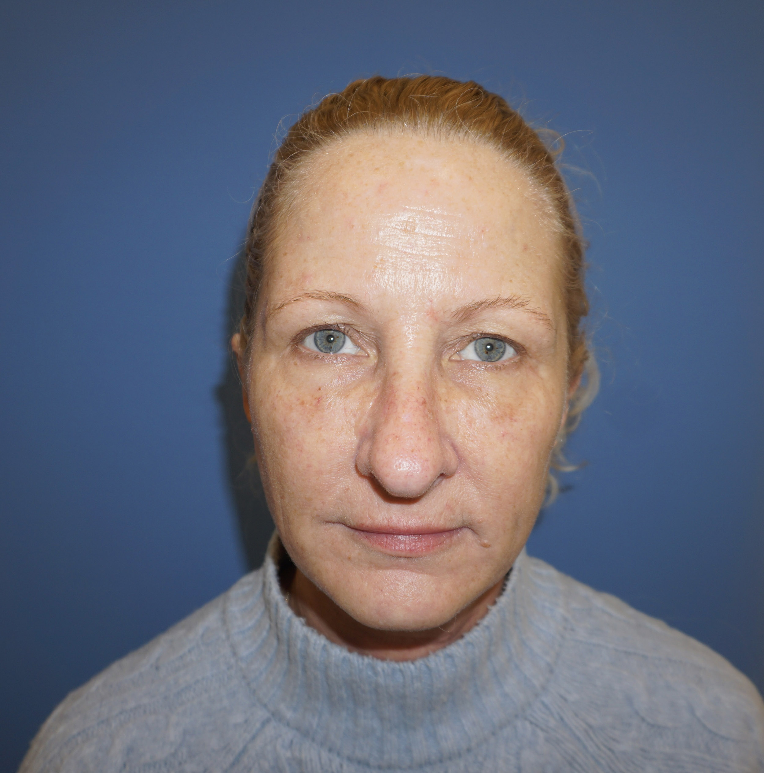 Blepharoplasty – Patient 10 Before