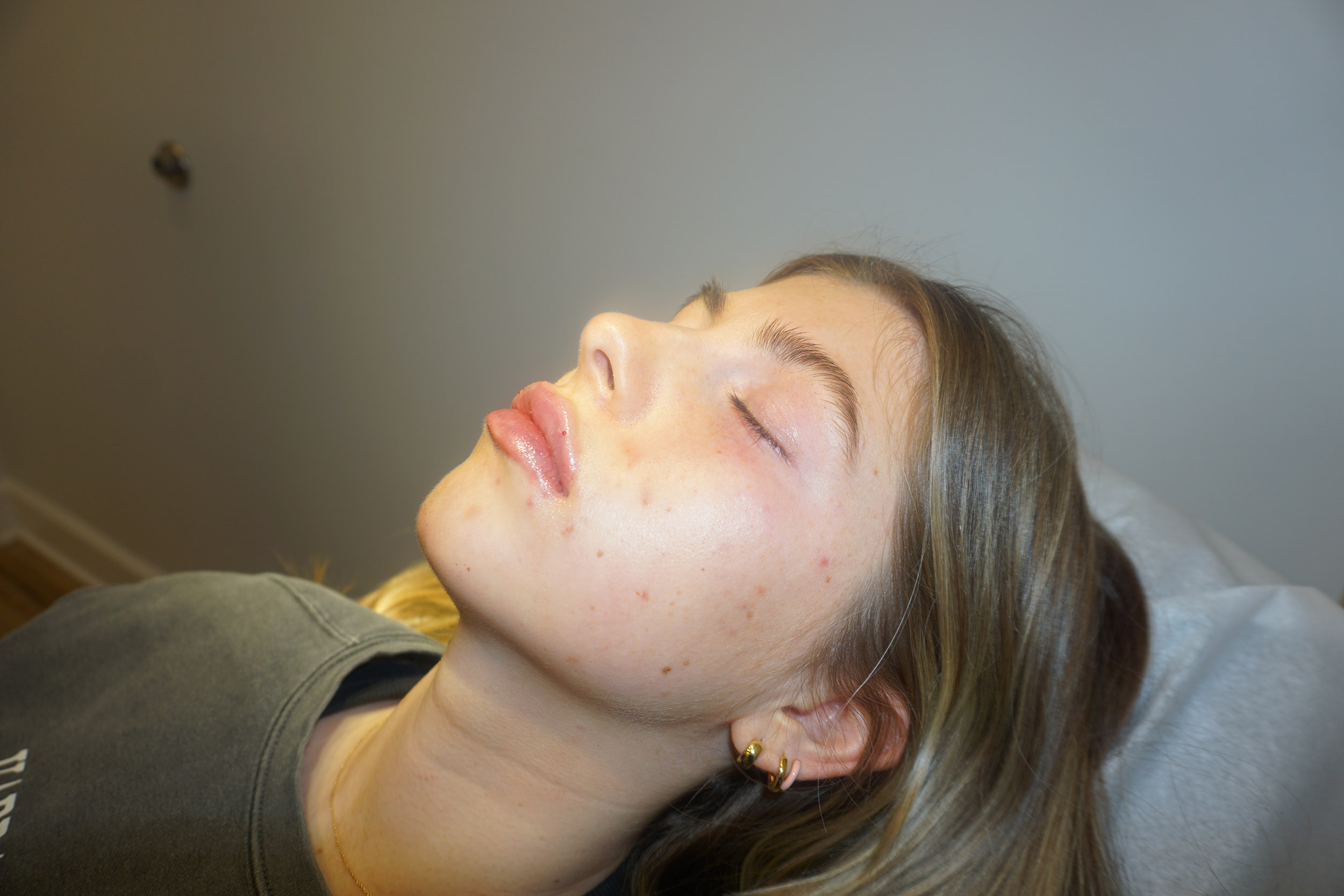 Botox – Patient 11 After