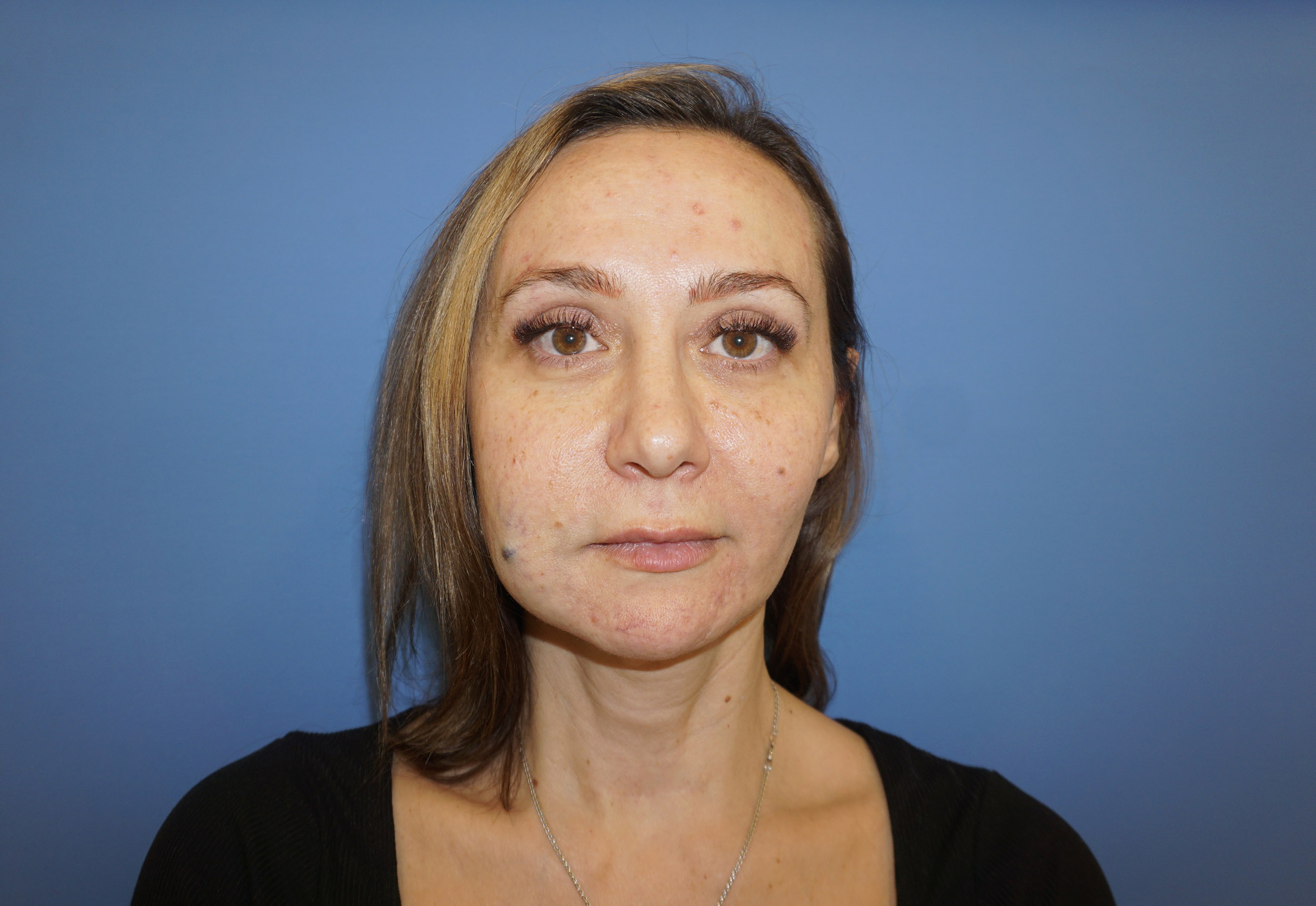 Blepharoplasty – Patient 11 After