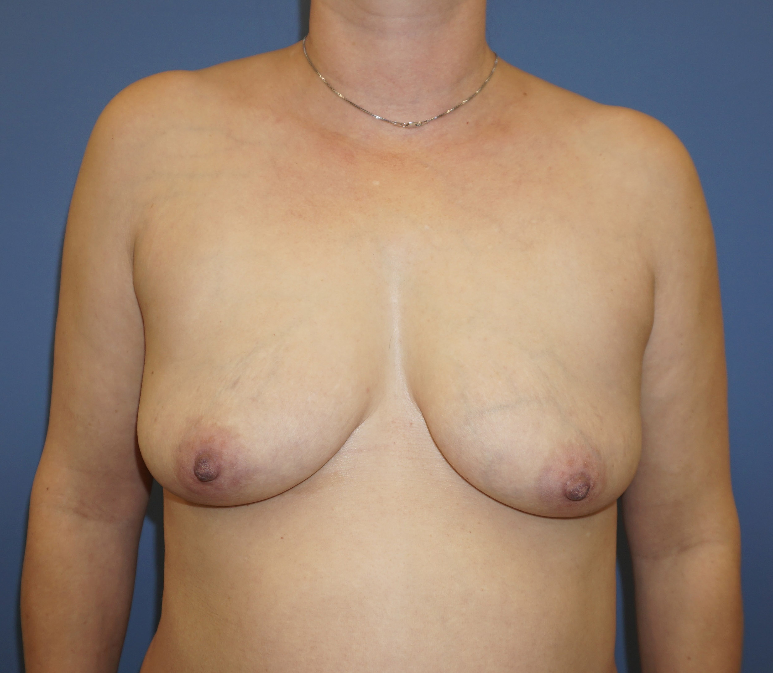 Breast Augmentation – Patient 11 Before