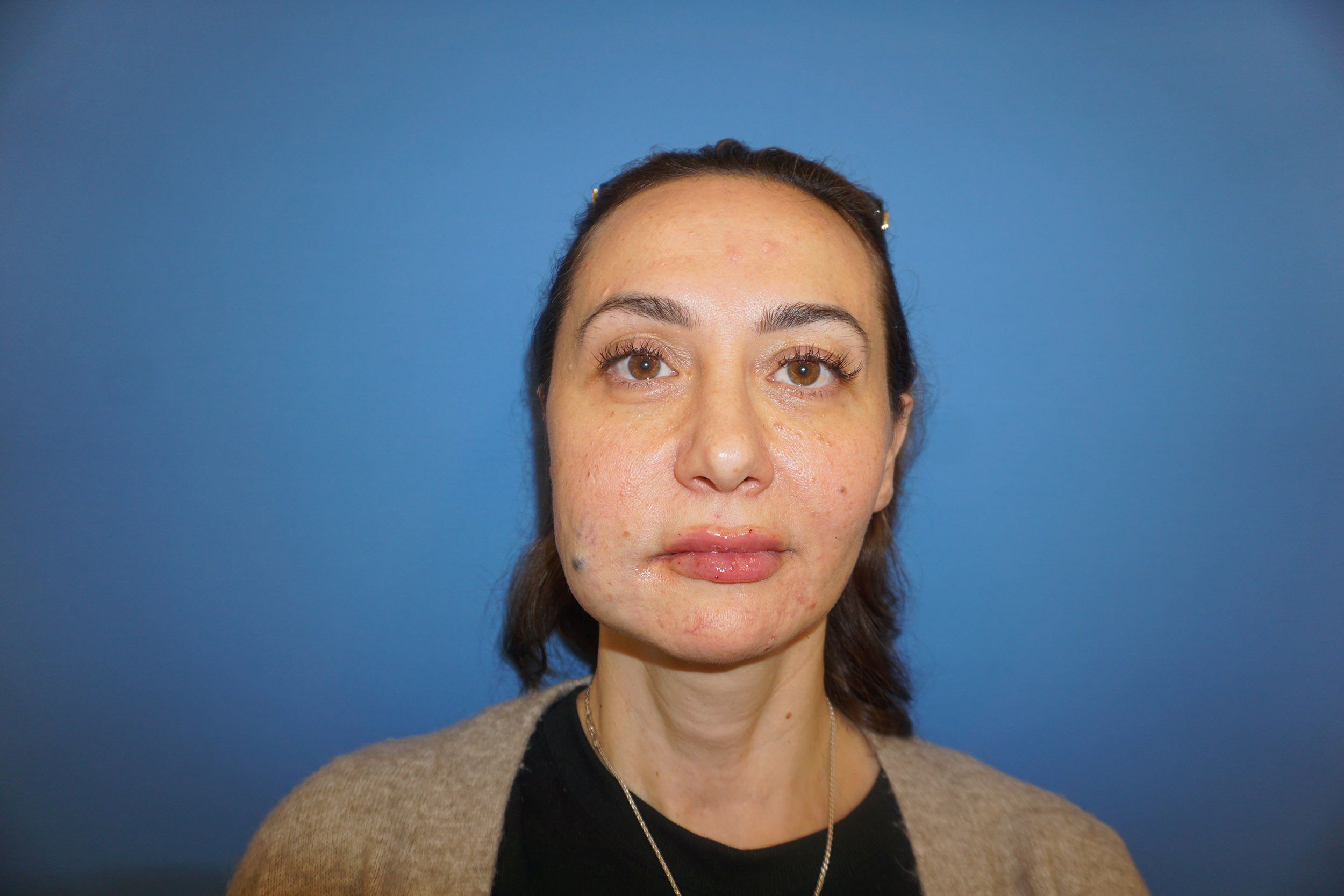 Blepharoplasty – Patient 11 Before