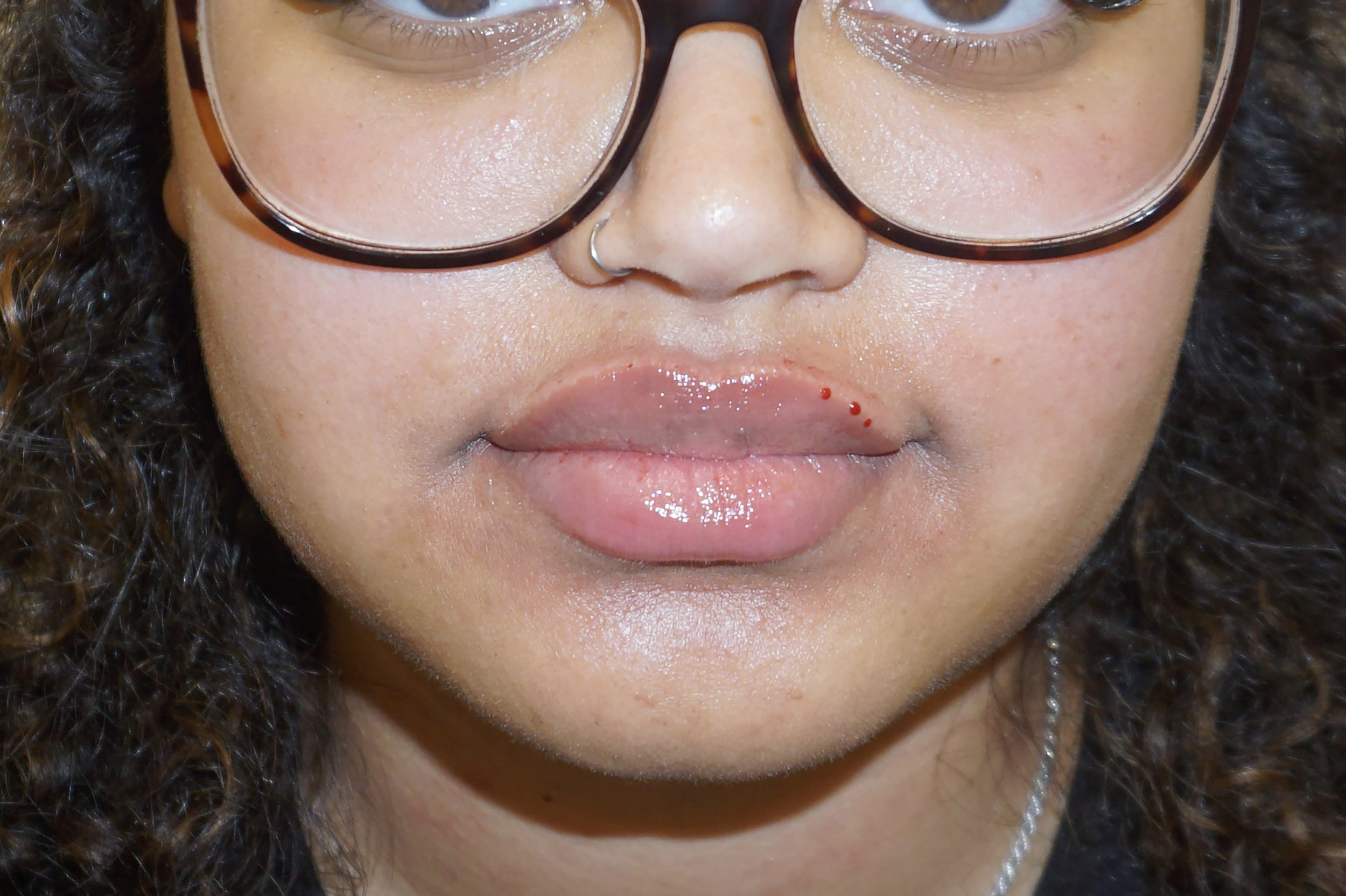 Botox – Patient 12 After