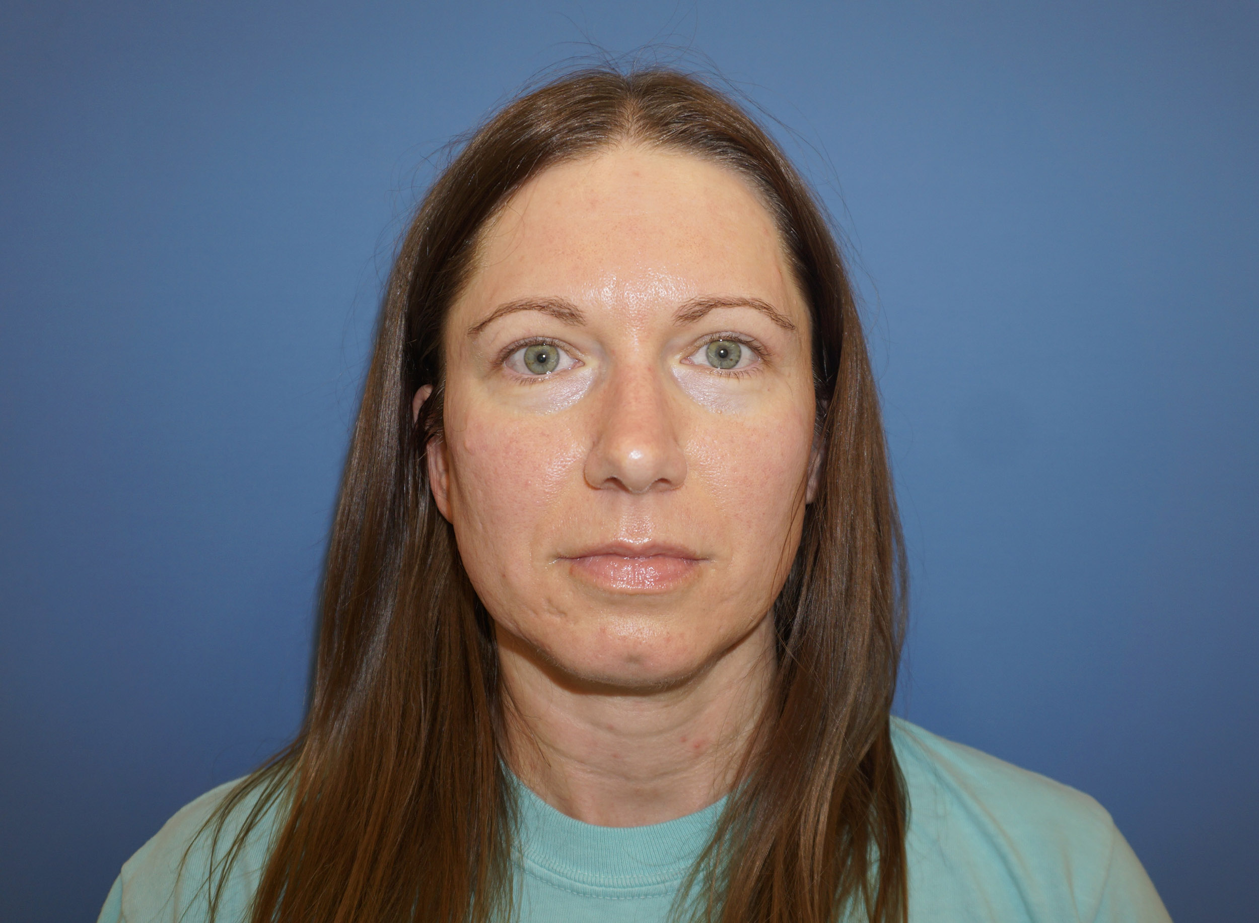 Blepharoplasty – Patient 12 After