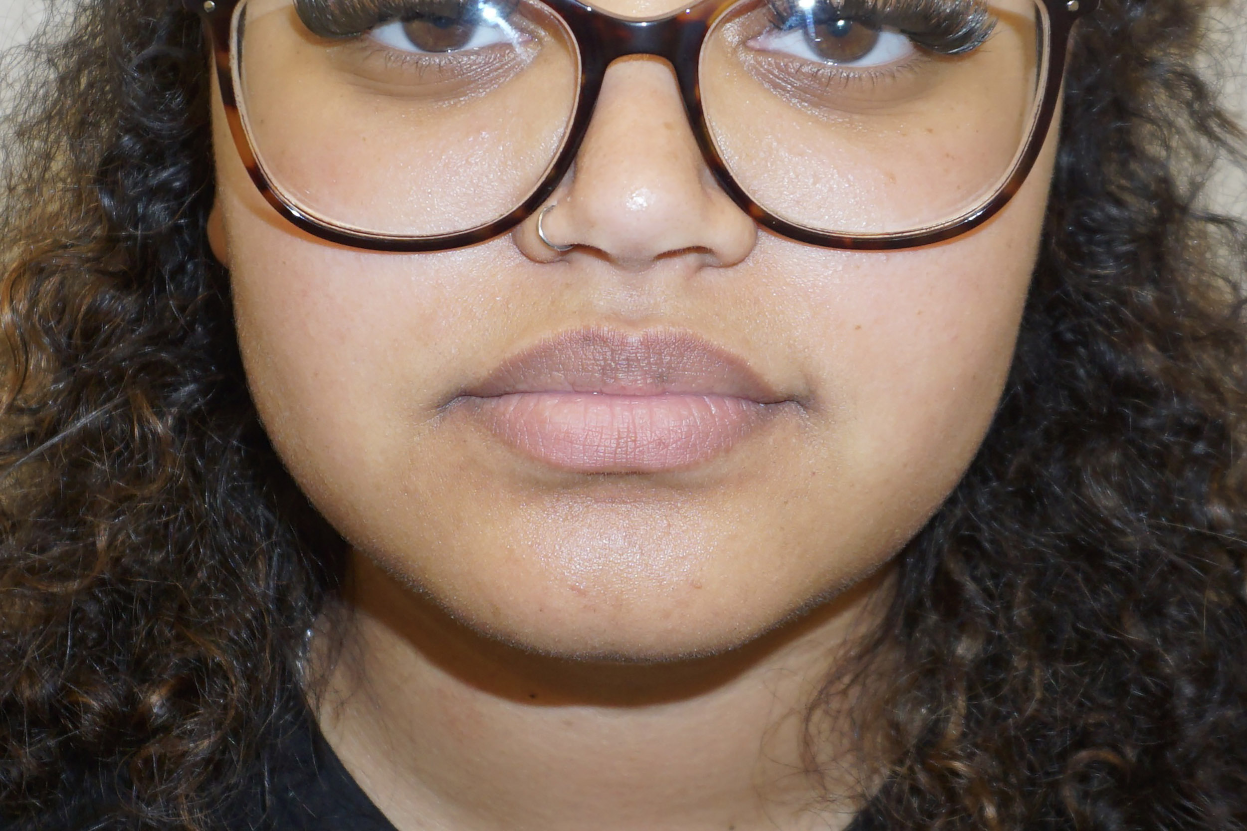 Botox – Patient 12 Before