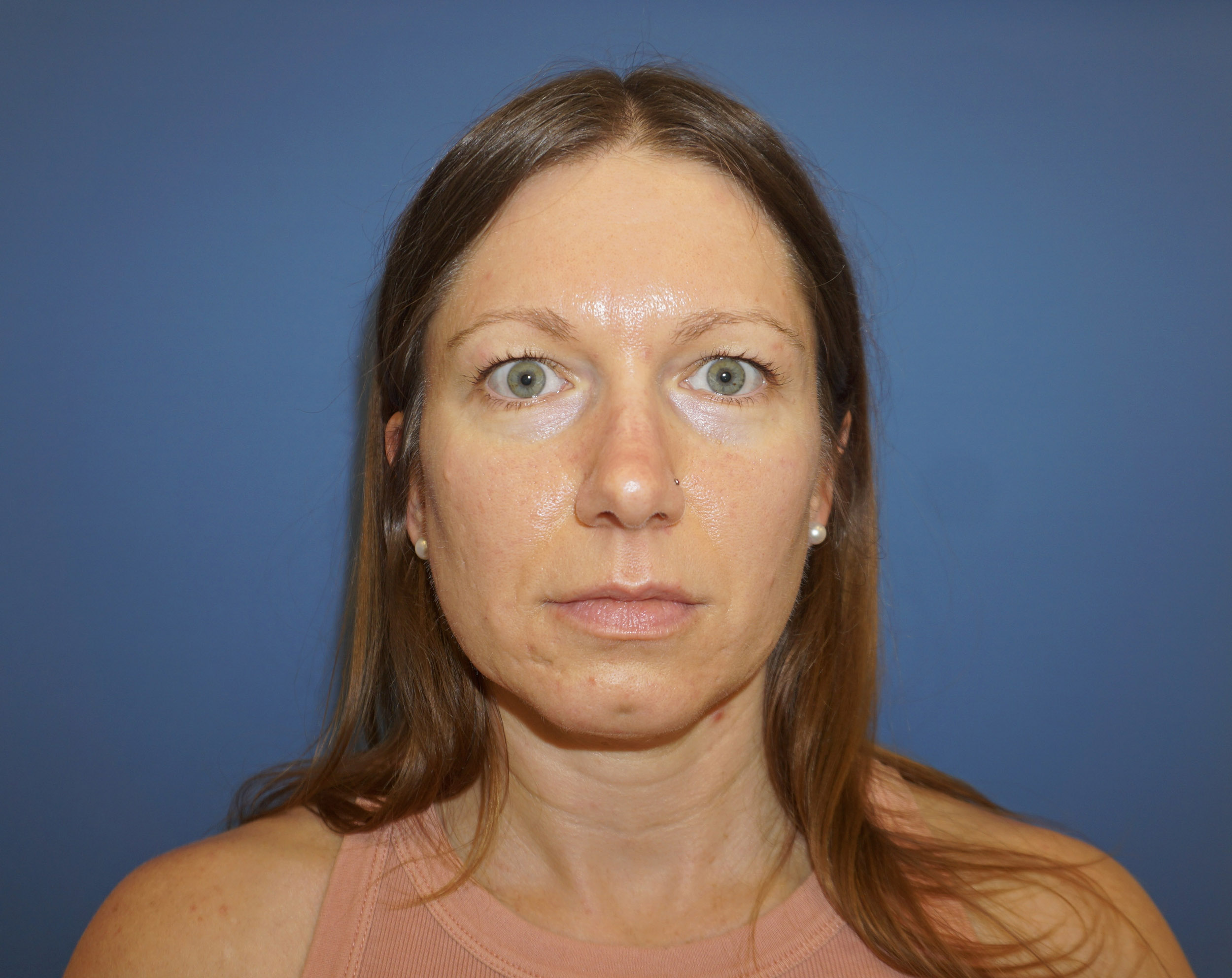 Blepharoplasty – Patient 12 Before