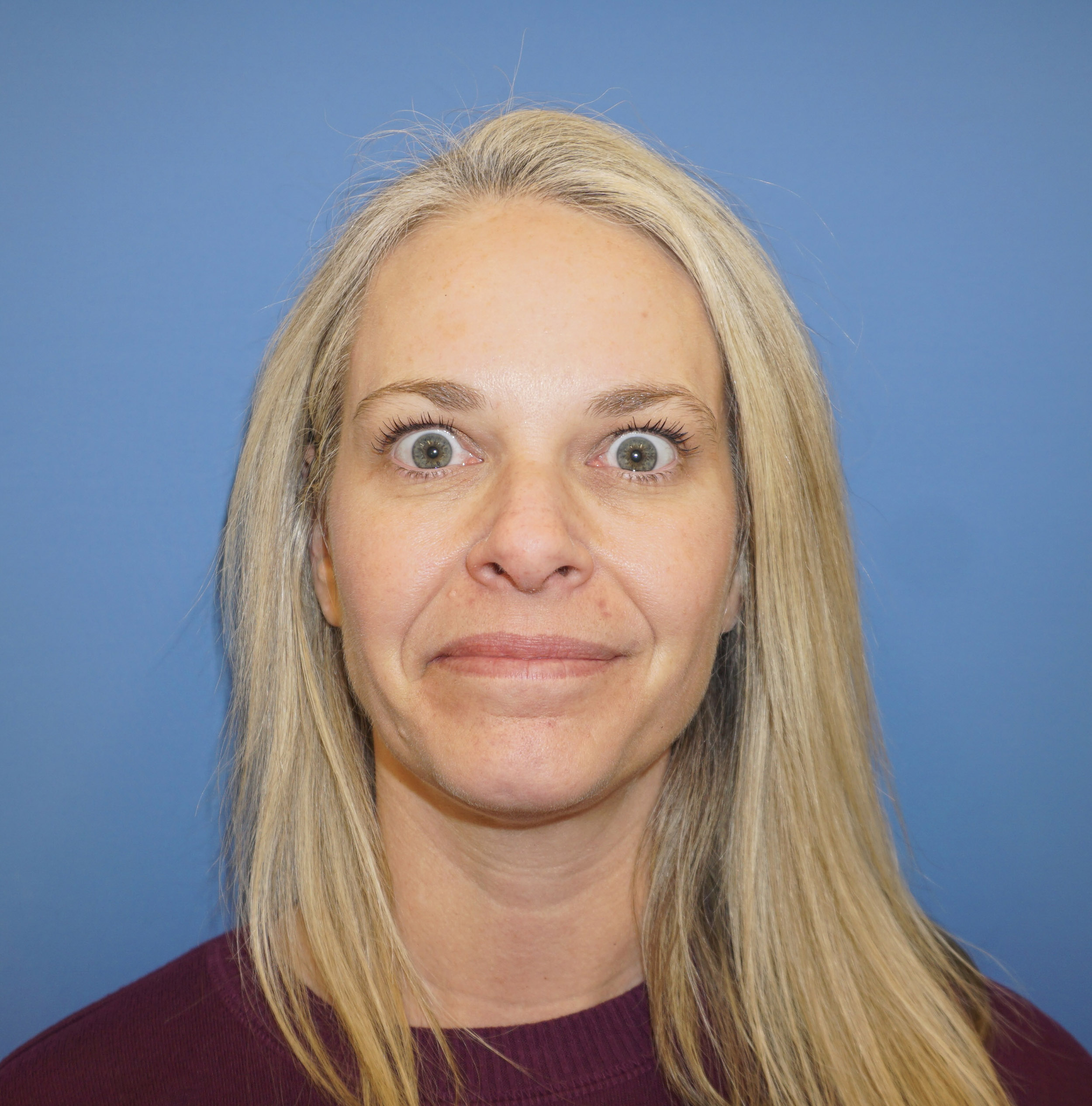 Botox – Patient 13 After