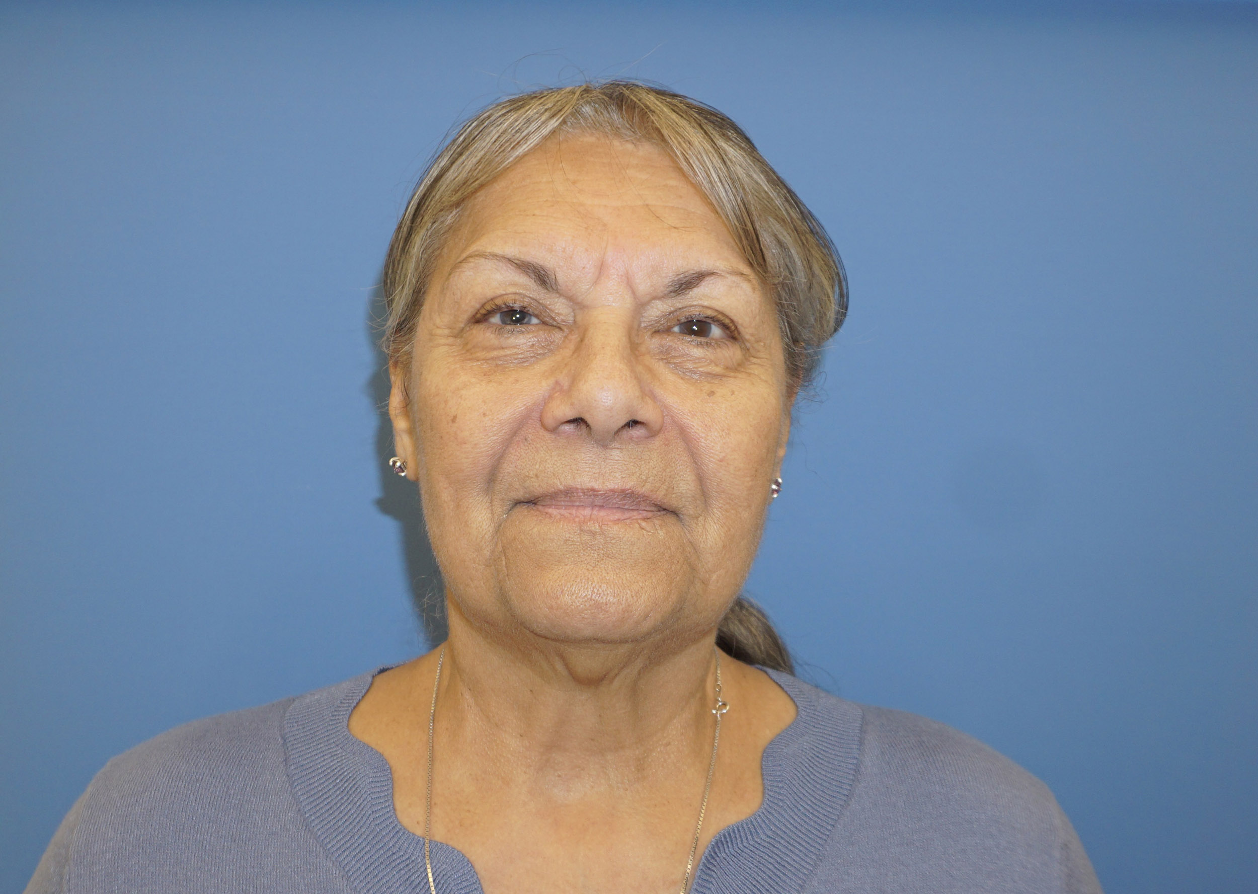 Blepharoplasty – Patient 13 After