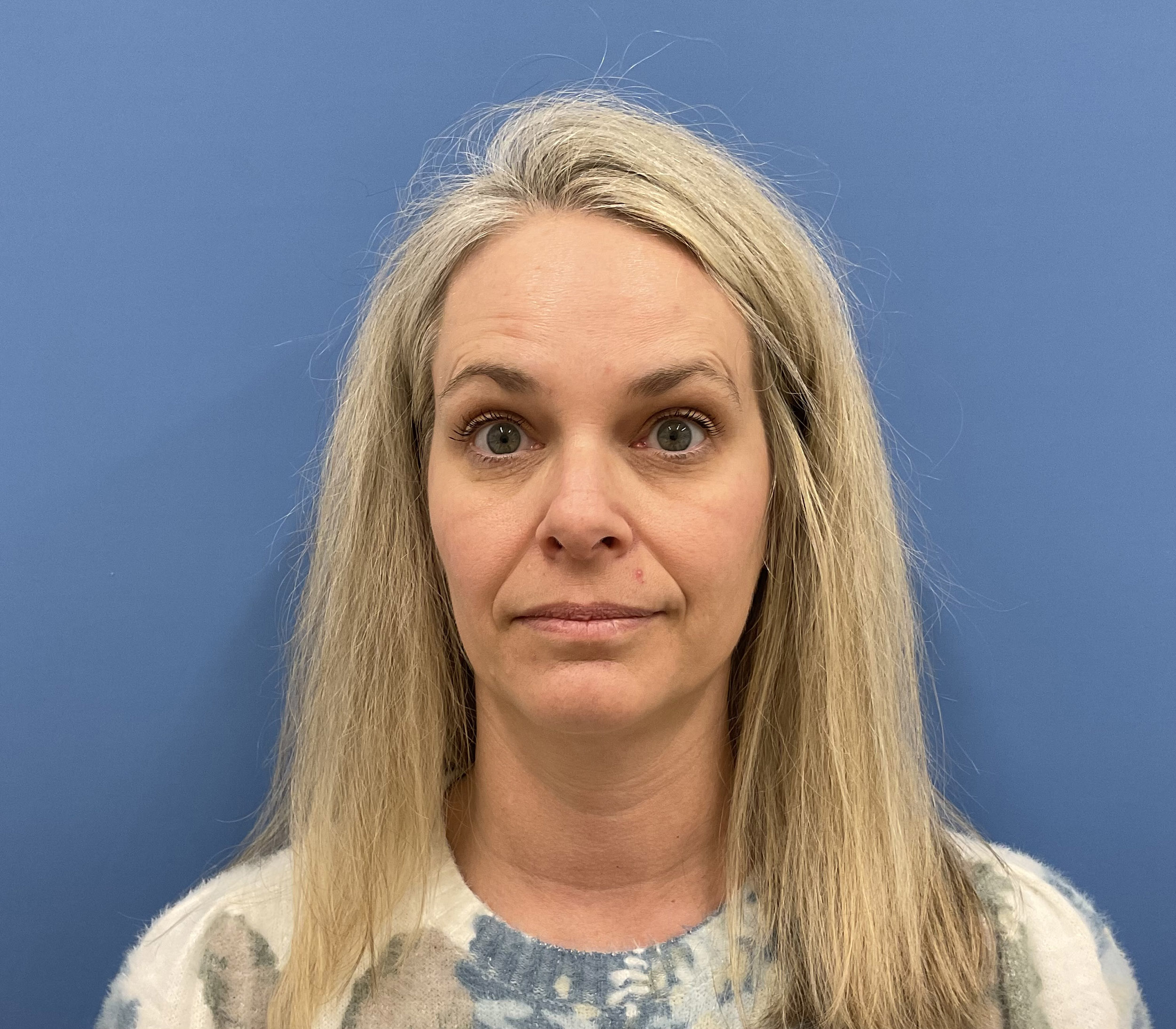 Botox – Patient 13 Before