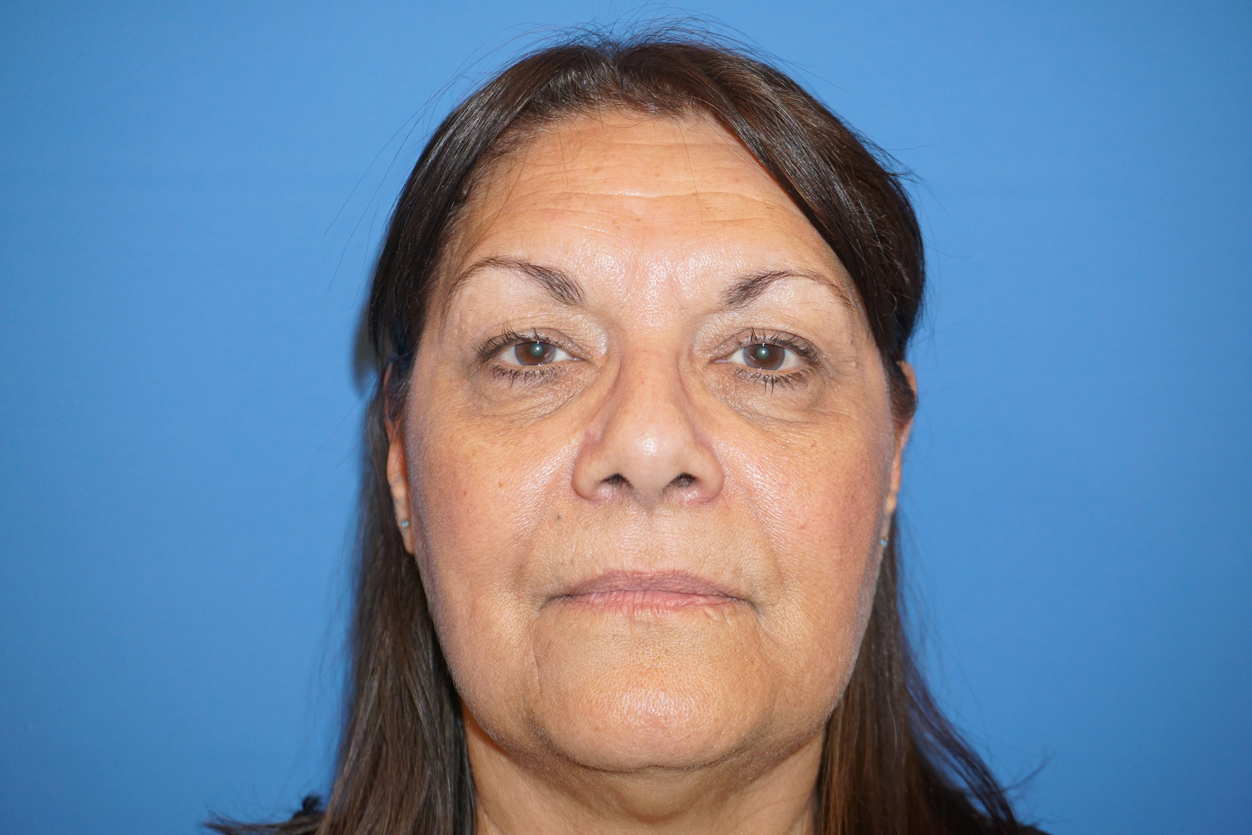 Blepharoplasty – Patient 13 Before