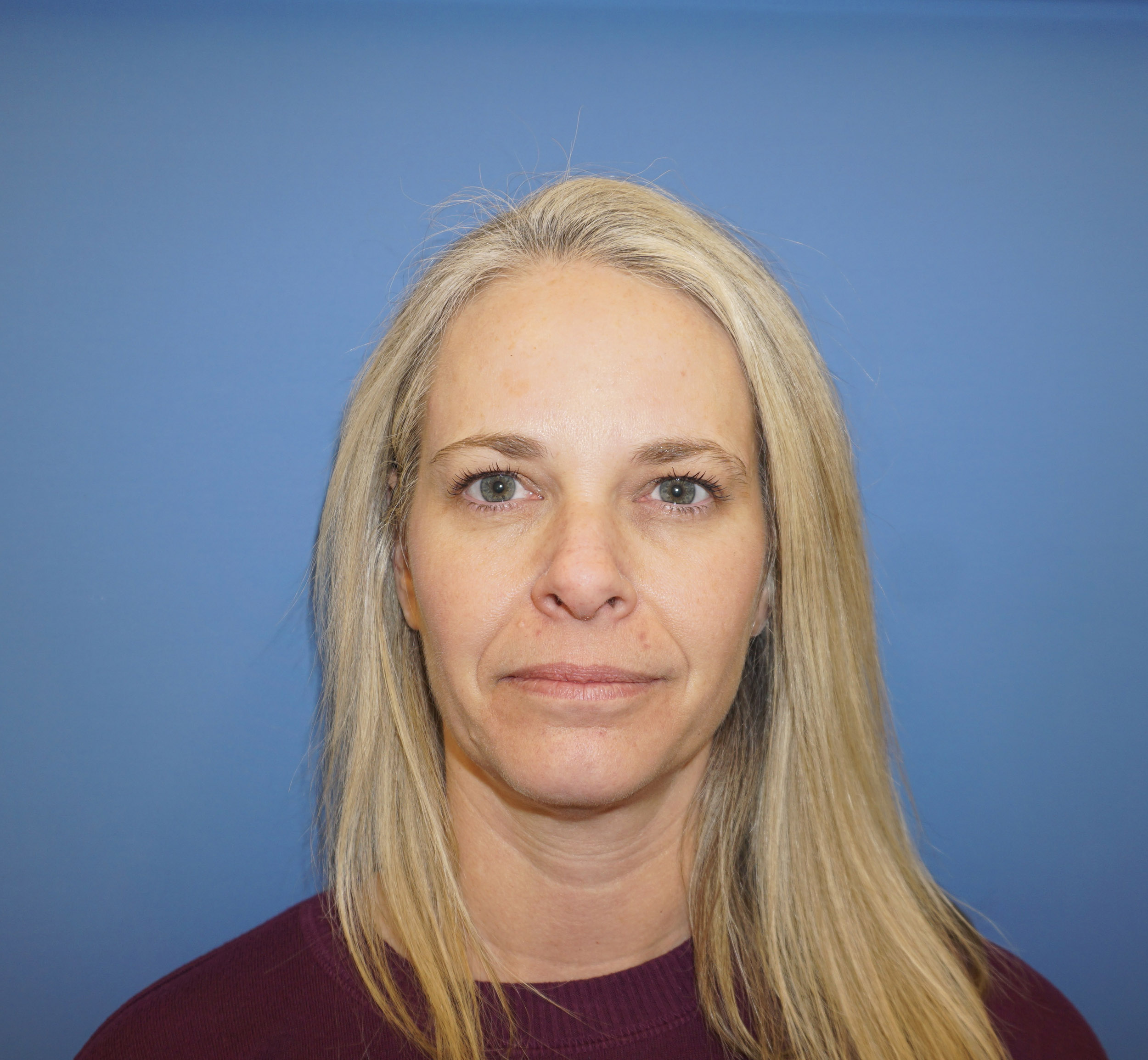 Botox – Patient 14 After