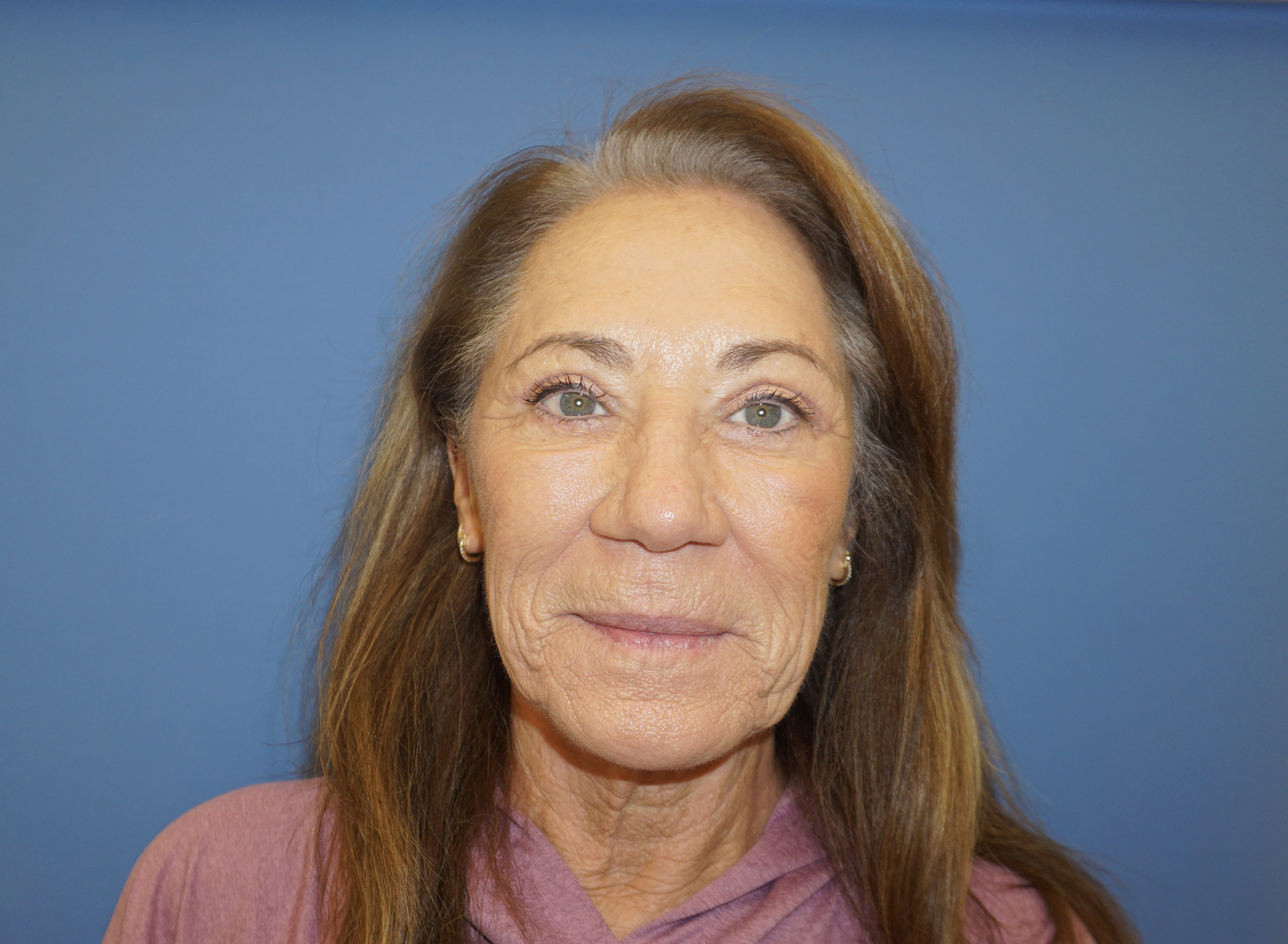 Blepharoplasty – Patient 14 After