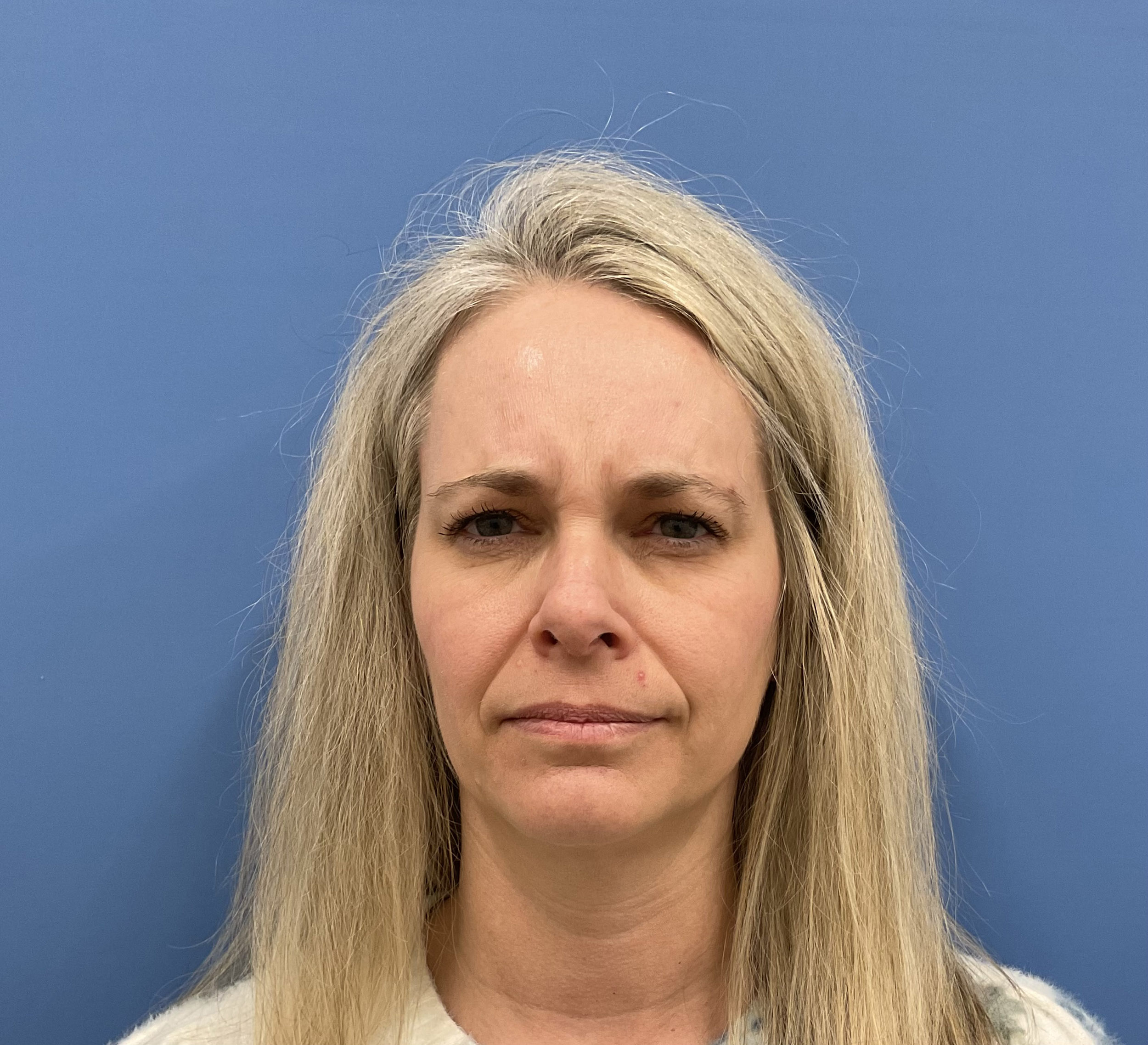 Botox – Patient 14 Before