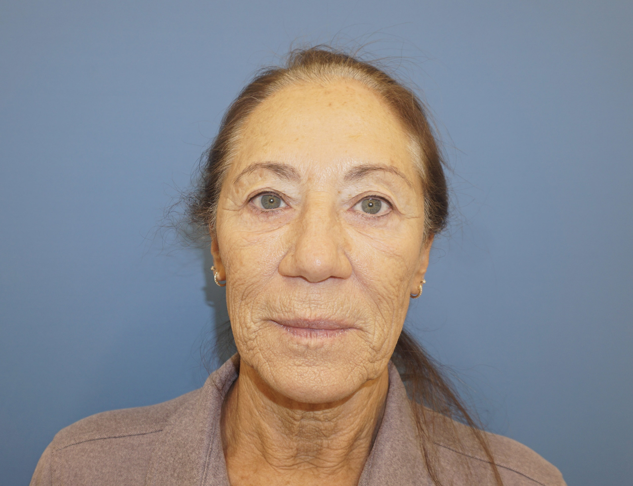 Blepharoplasty – Patient 14 Before