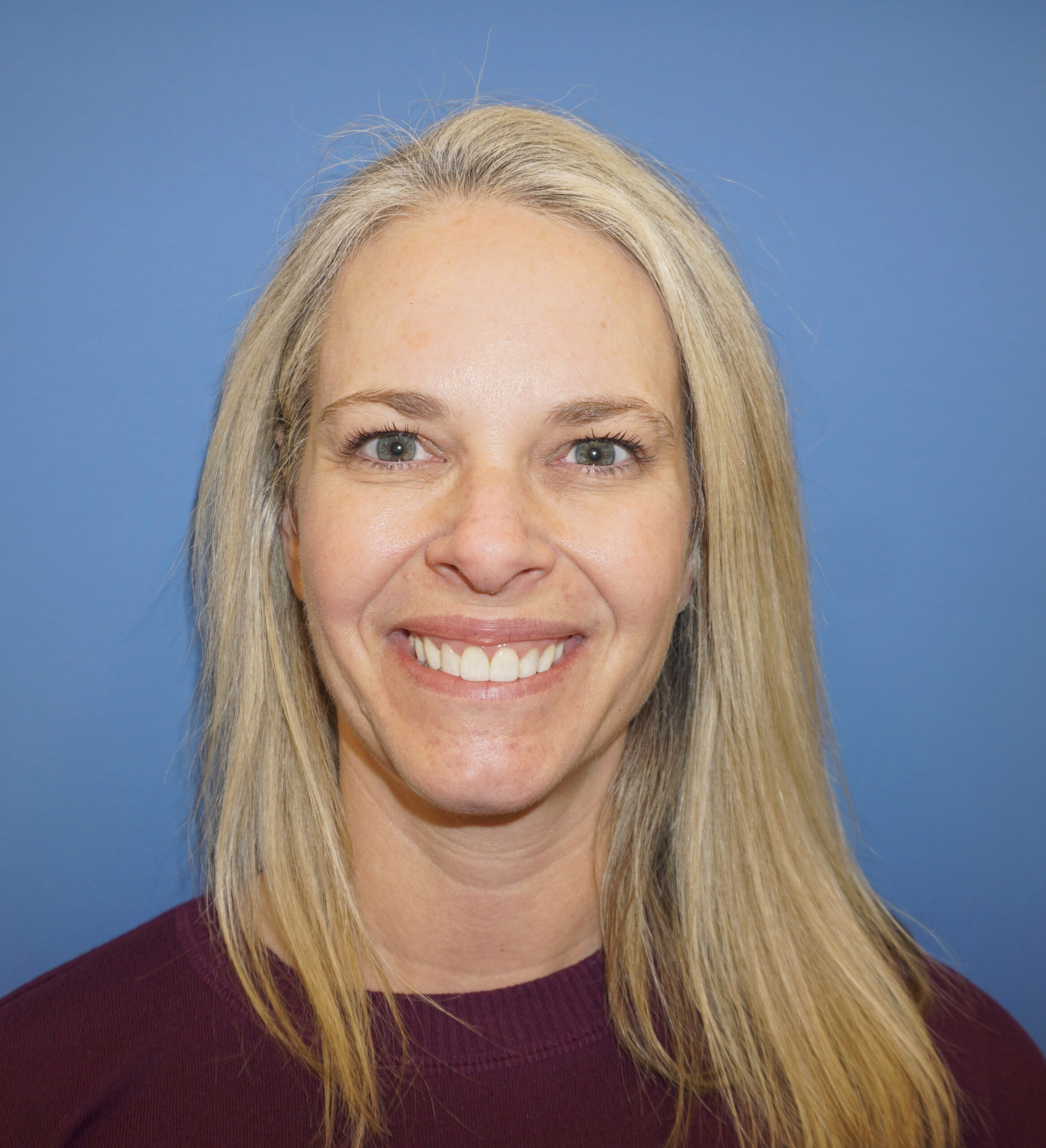 Botox – Patient 15 After