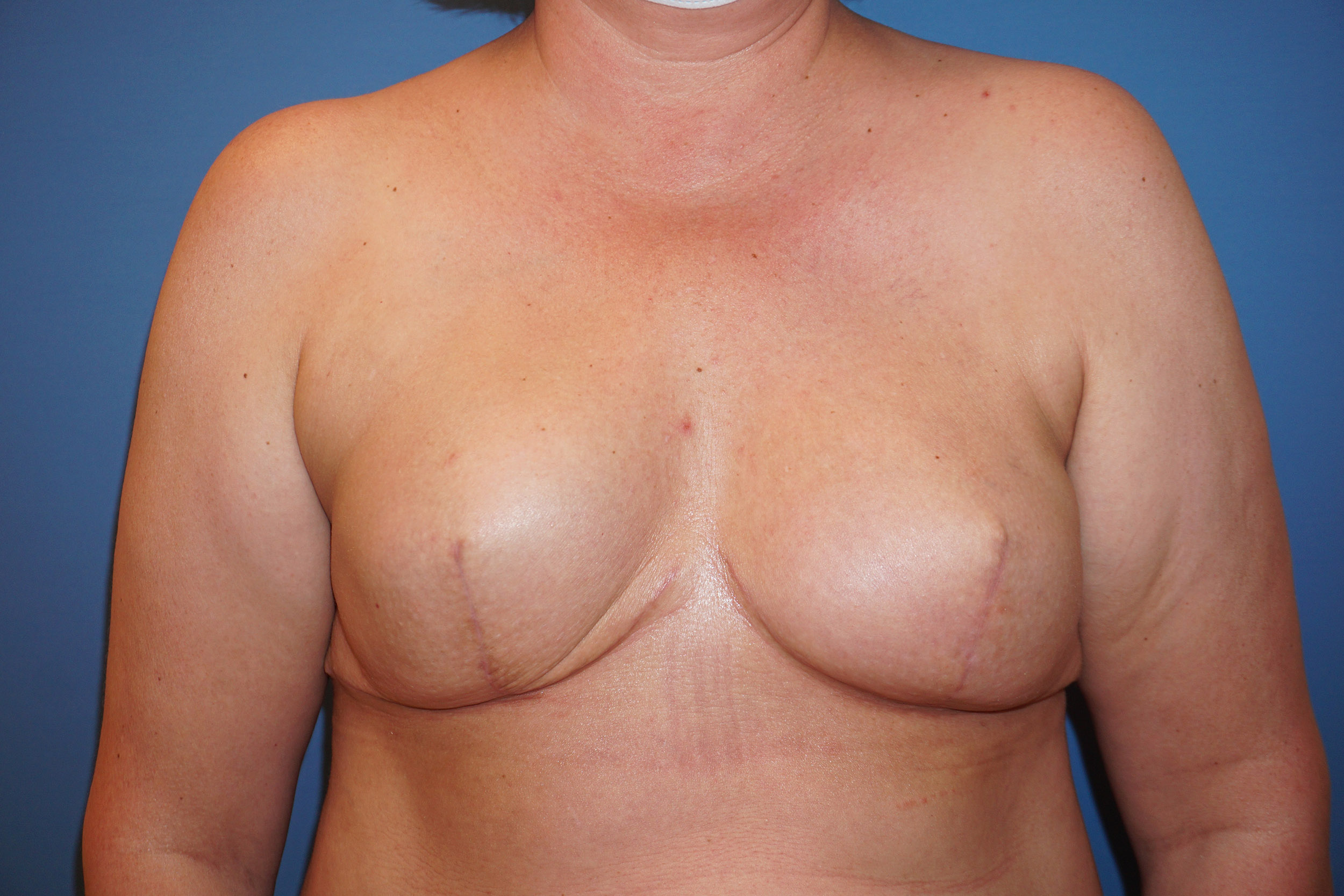 Breast Reconstruction for Cancer – Patient 15 After